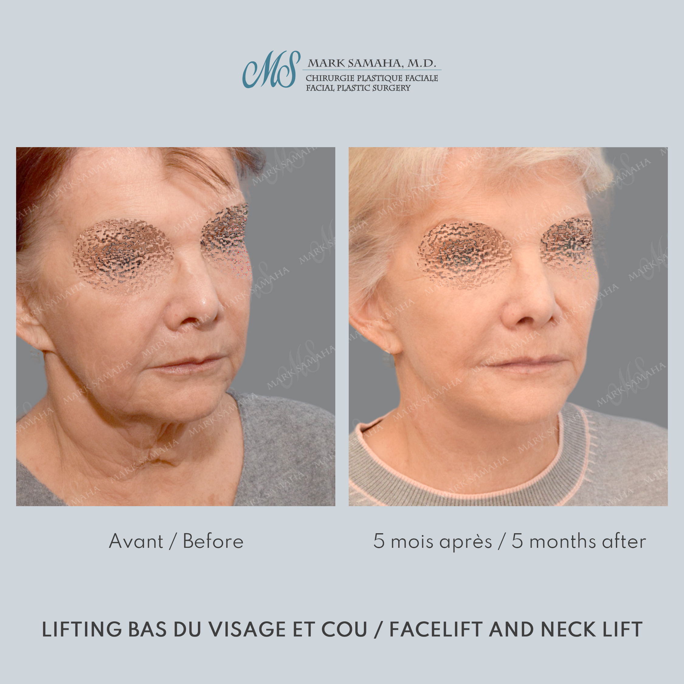 Before & After Lifting du visage / Cou - Facelift / Necklift Case 242 View #5 Detail View in Montreal, QC