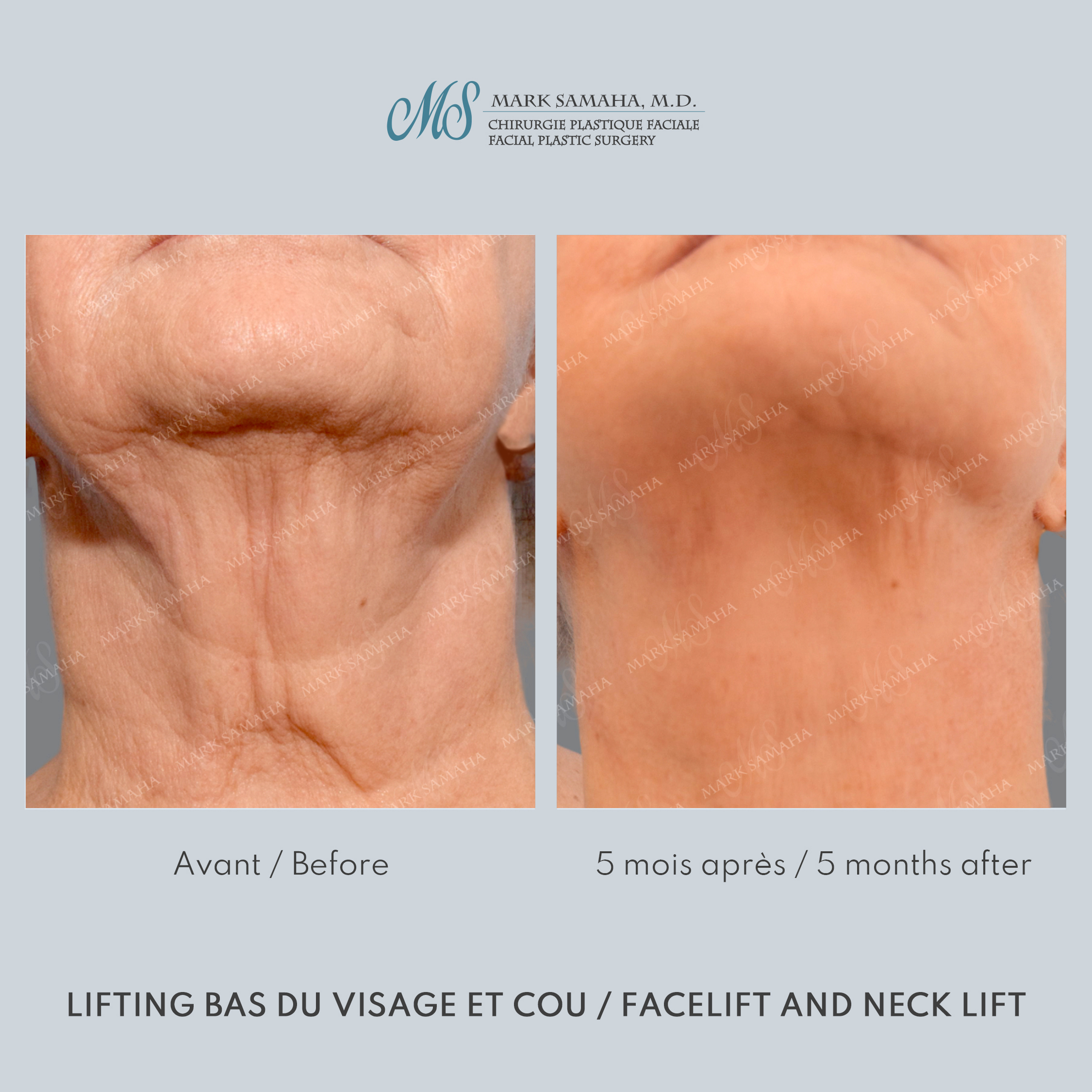 Before & After Lifting du visage / Cou - Facelift / Necklift Case 242 View #6 Detail View in Montreal, QC