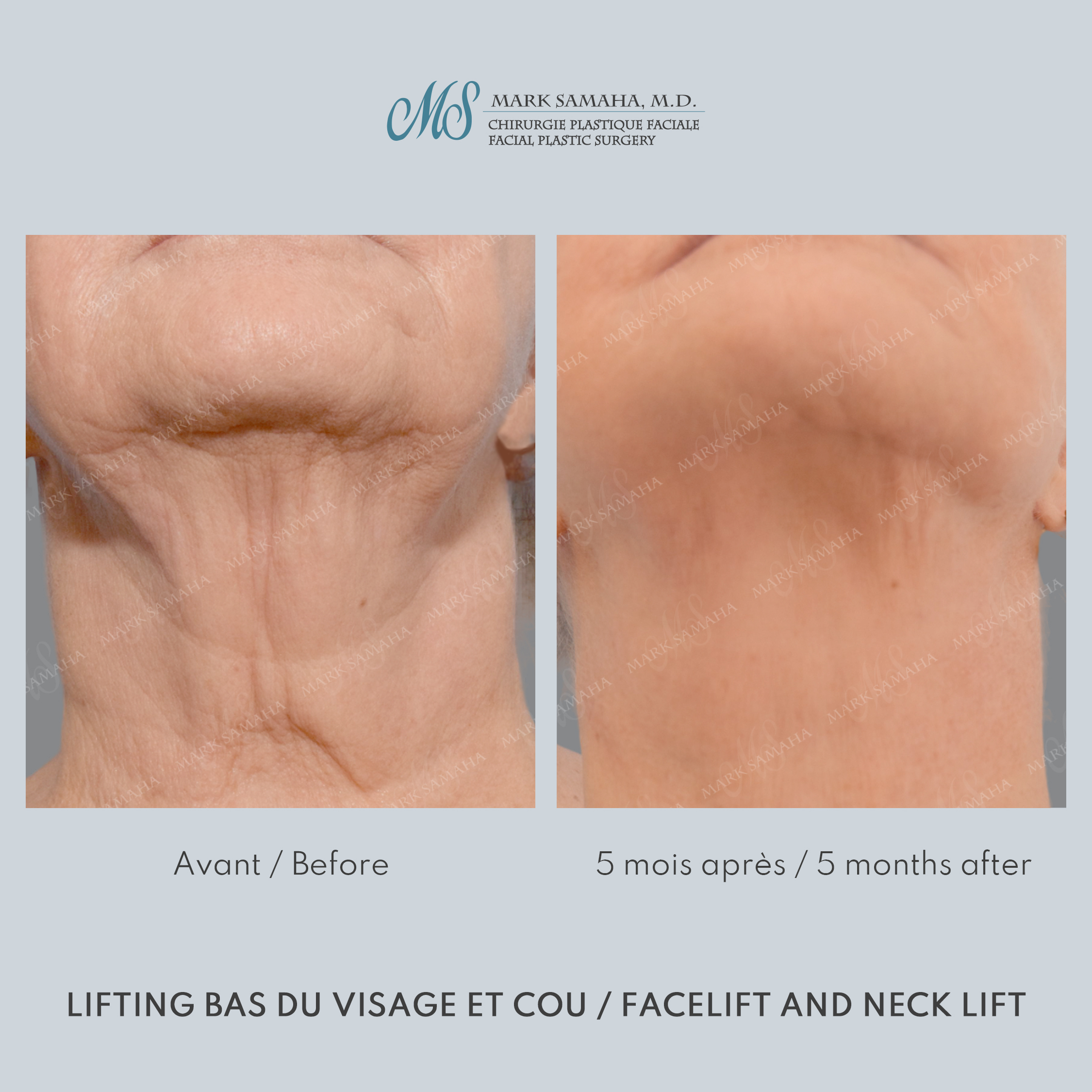 Before & After Lifting du visage / Cou - Facelift / Necklift Case 242 View #6 View in Montreal, QC