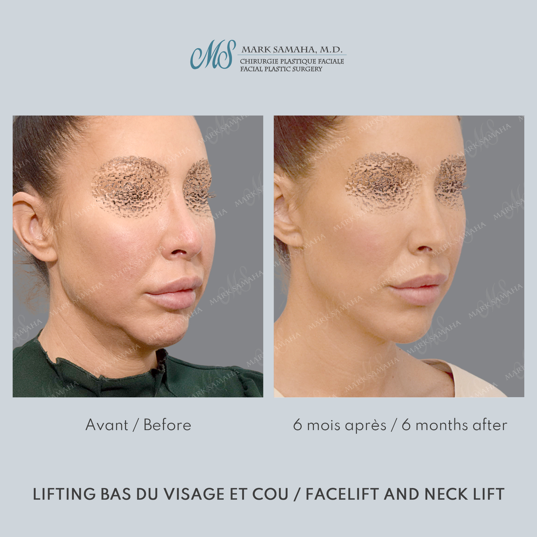 Before & After Lifting du visage / Cou - Facelift / Necklift Case 243 View #1 Detail View in Montreal, QC