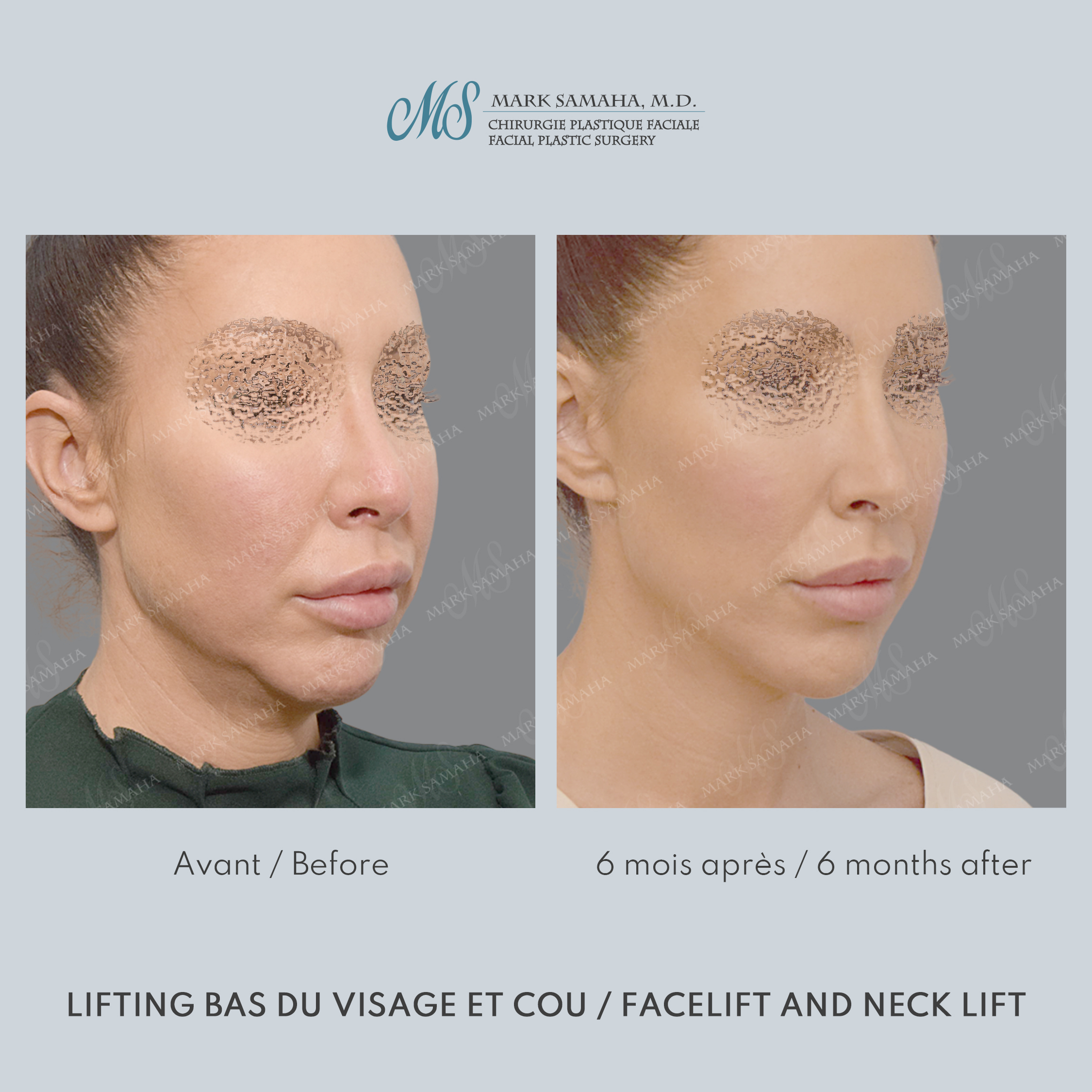 Before & After Lifting du visage / Cou - Facelift / Necklift Case 243 View #1 View in Montreal, QC