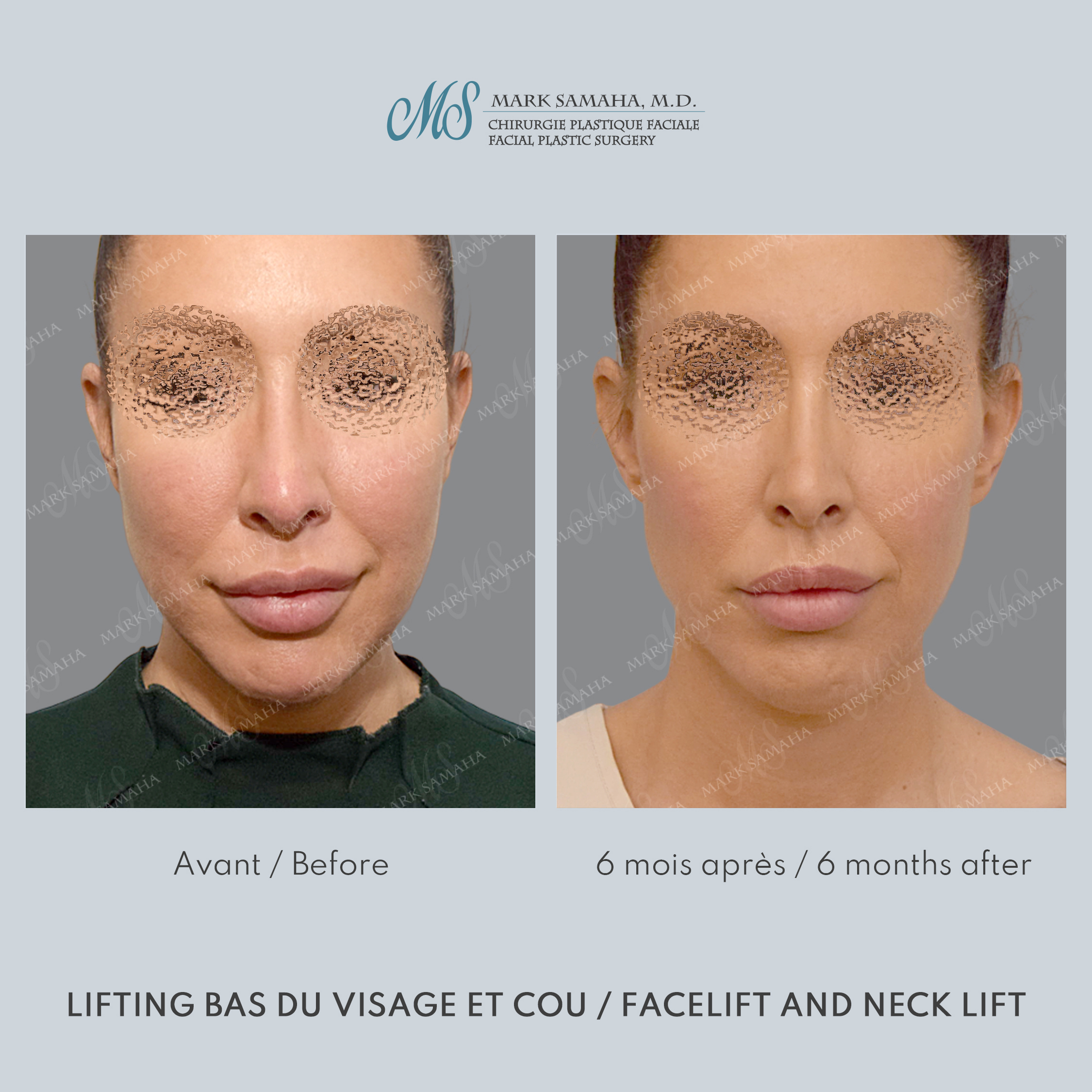Before & After Lifting du visage / Cou - Facelift / Necklift Case 243 View #2 Detail View in Montreal, QC
