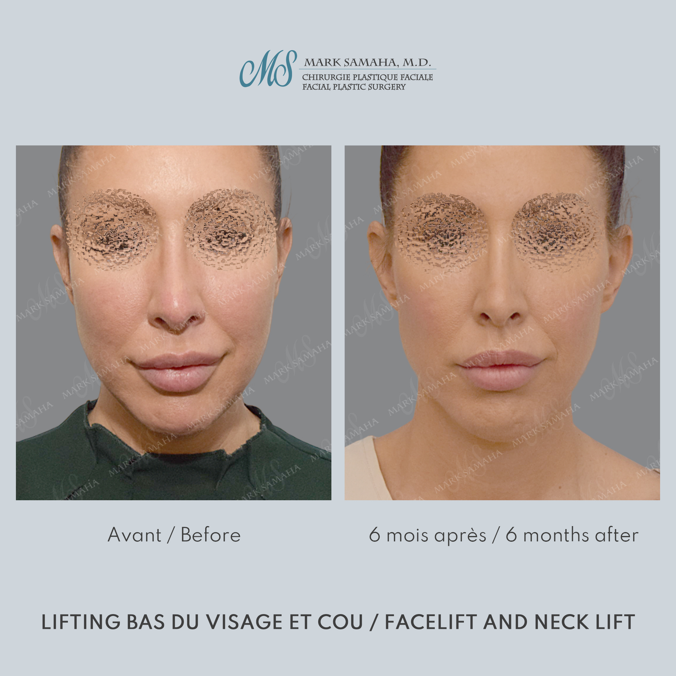 Before & After Lifting du visage / Cou - Facelift / Necklift Case 243 View #2 View in Montreal, QC