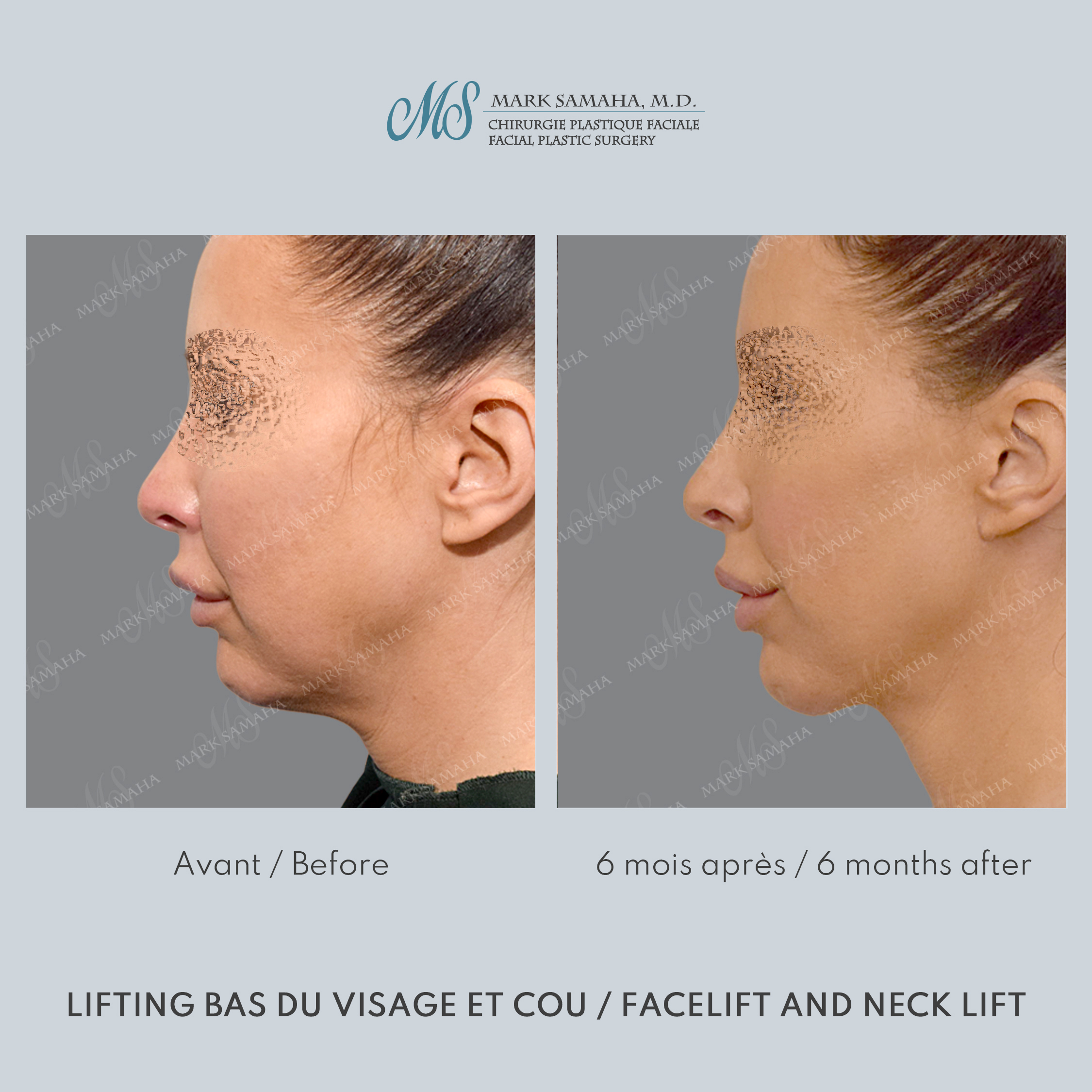 Before & After Lifting du visage / Cou - Facelift / Necklift Case 243 View #3 Detail View in Montreal, QC