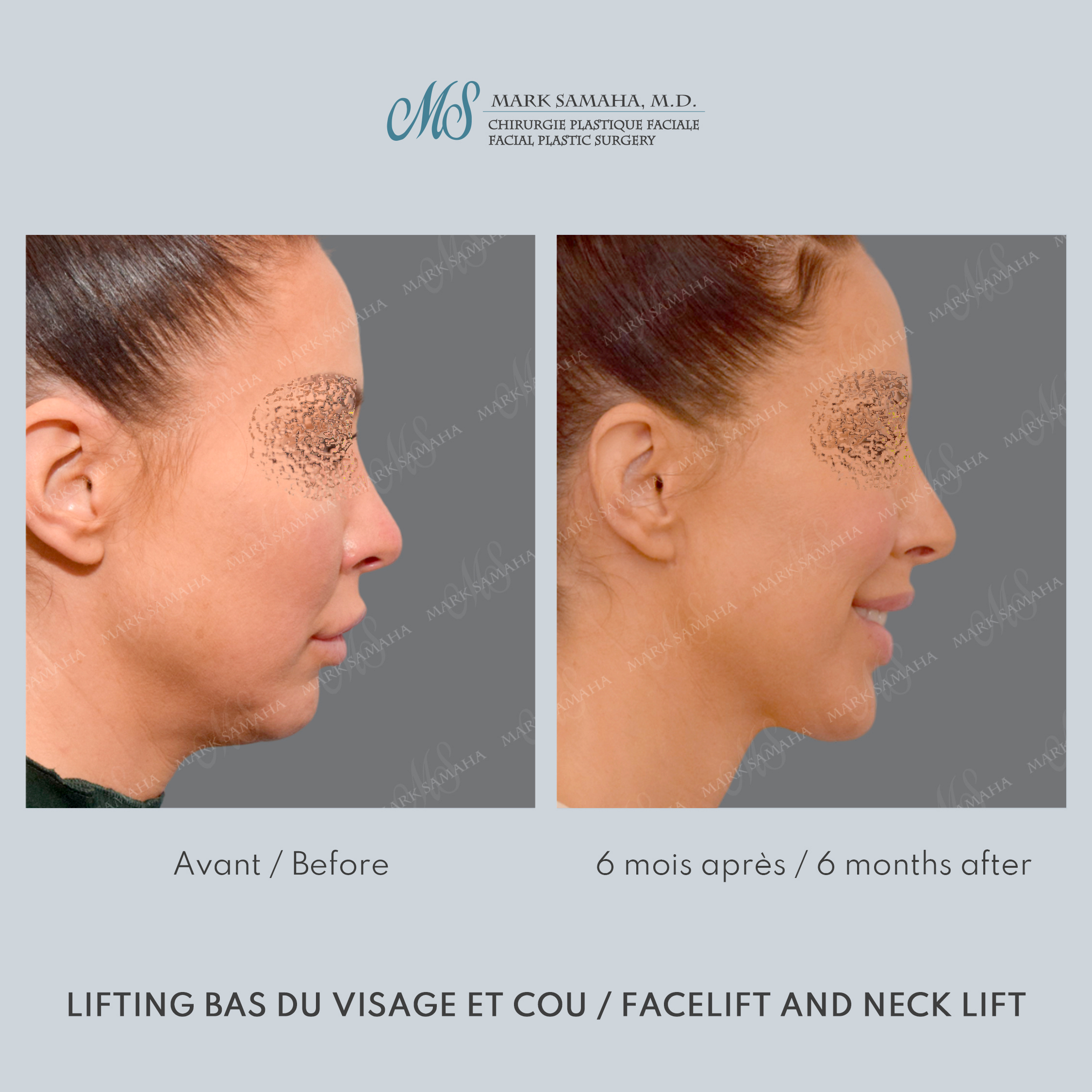Before & After Lifting du visage / Cou - Facelift / Necklift Case 243 View #4 Detail View in Montreal, QC