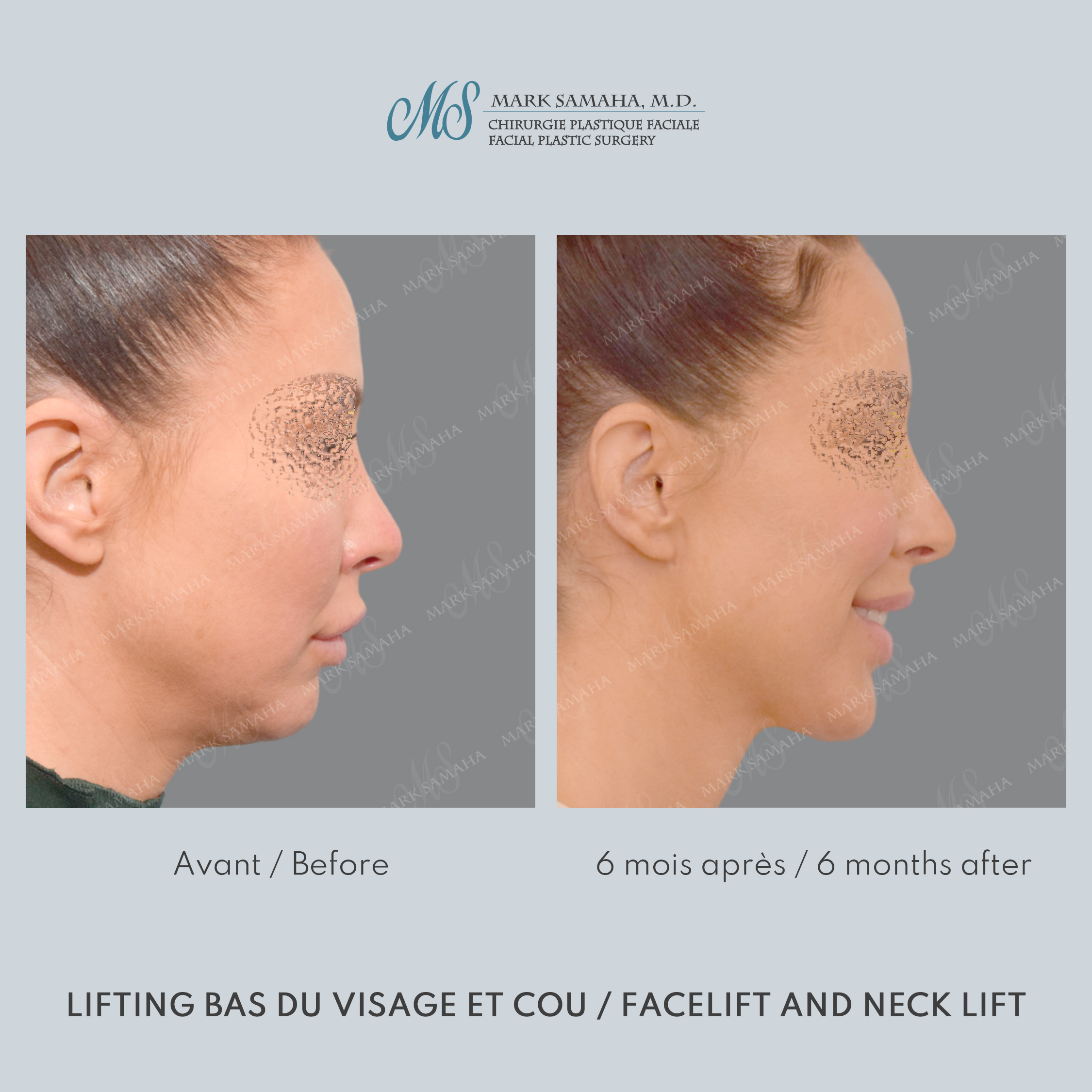 Before & After Lifting du visage / Cou - Facelift / Necklift Case 243 View #4 View in Montreal, QC