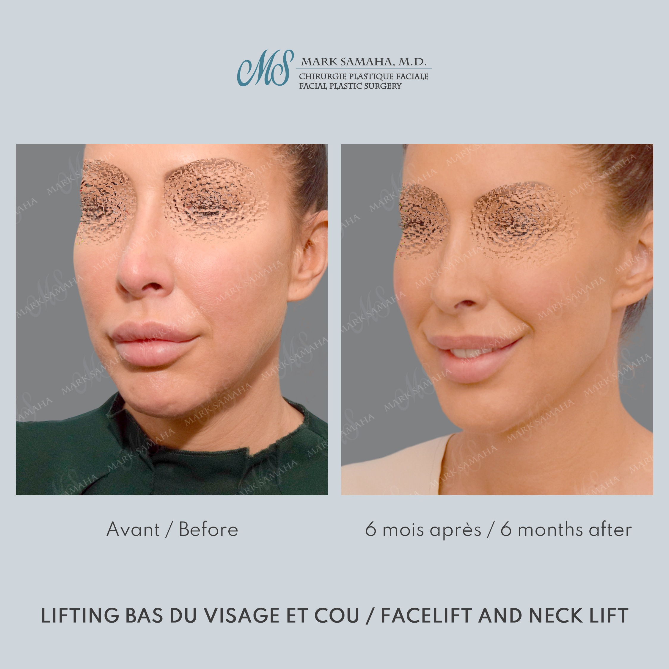 Before & After Lifting du visage / Cou - Facelift / Necklift Case 243 View #5 Detail View in Montreal, QC