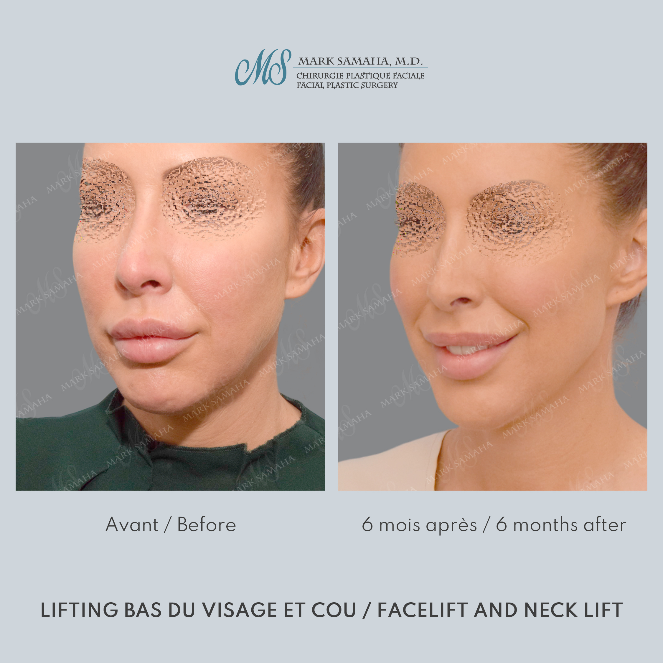 Before & After Lifting du visage / Cou - Facelift / Necklift Case 243 View #5 View in Montreal, QC
