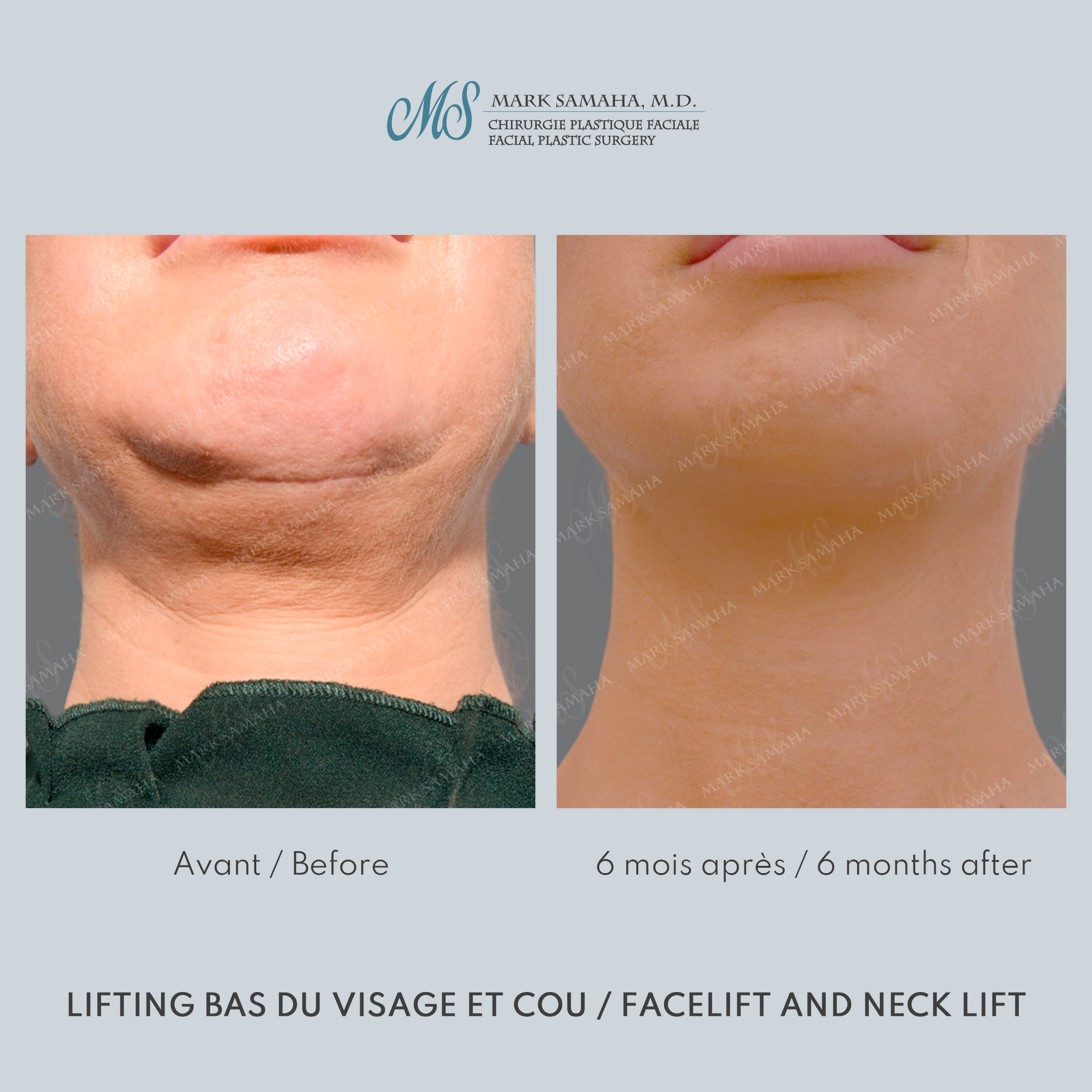 Before & After Lifting du visage / Cou - Facelift / Necklift Case 243 View #6 Detail View in Montreal, QC