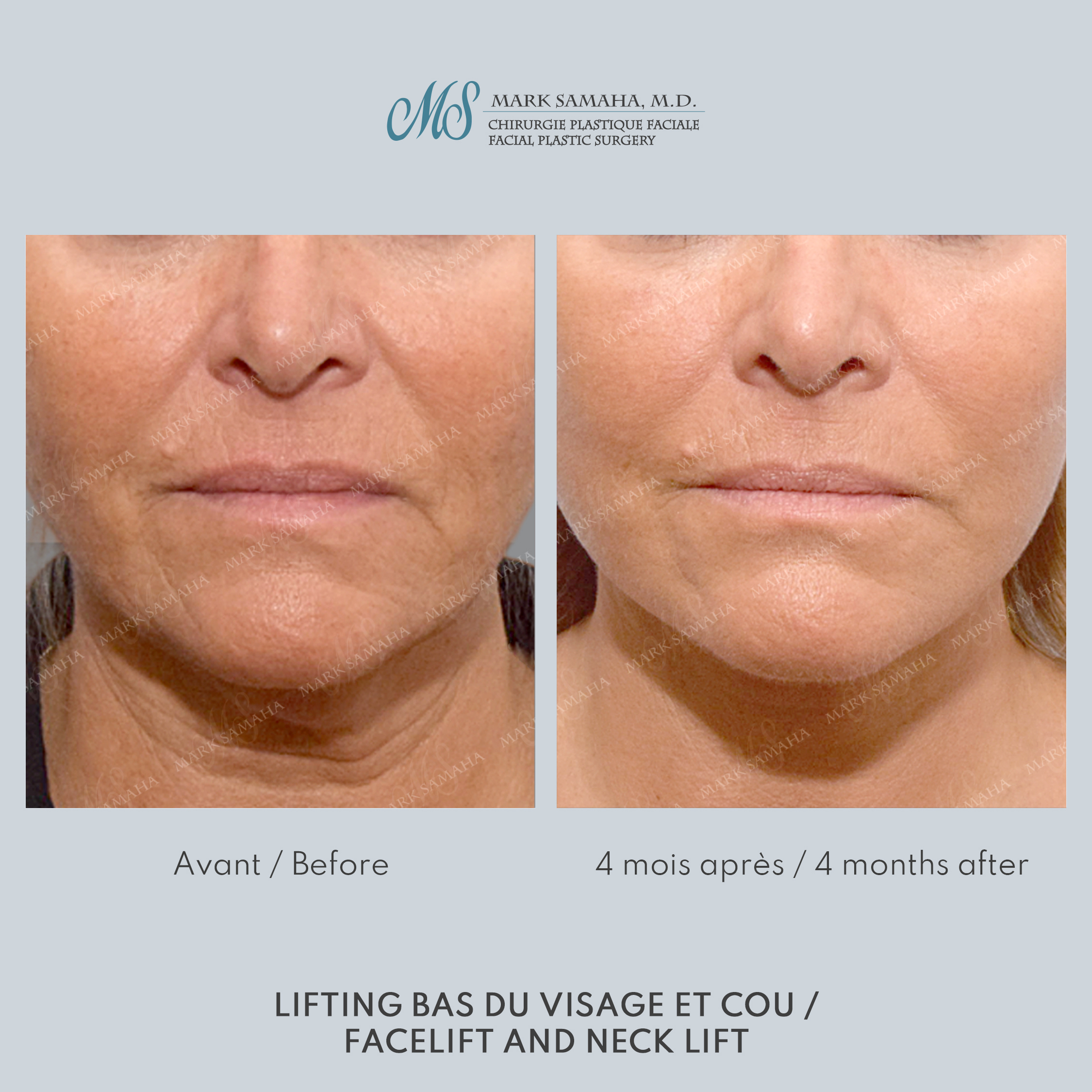 Before & After Lifting du visage / Cou - Facelift / Necklift Case 244 View #1 Detail View in Montreal, QC
