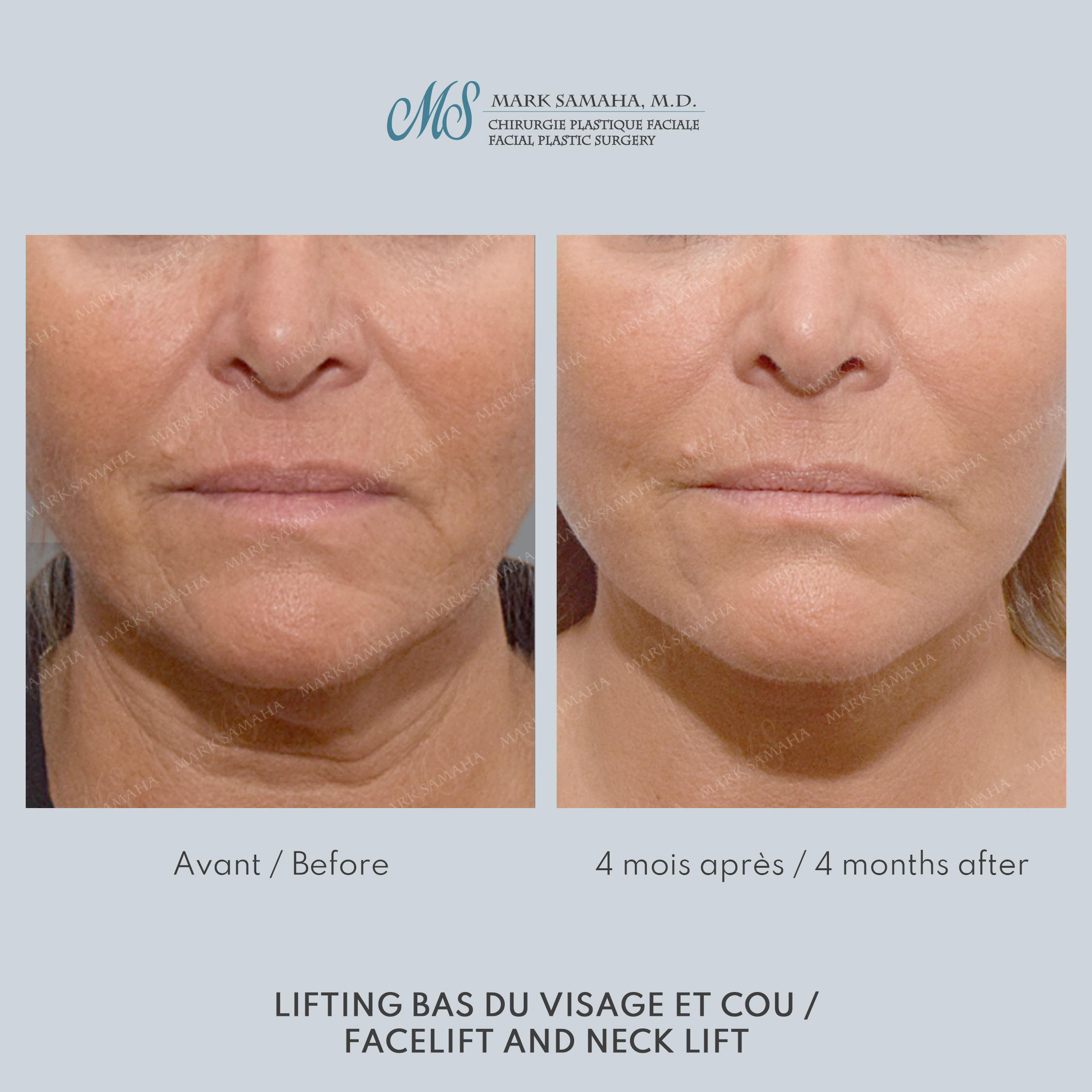 Before & After Lifting du visage / Cou - Facelift / Necklift Case 244 View #1 View in Montreal, QC