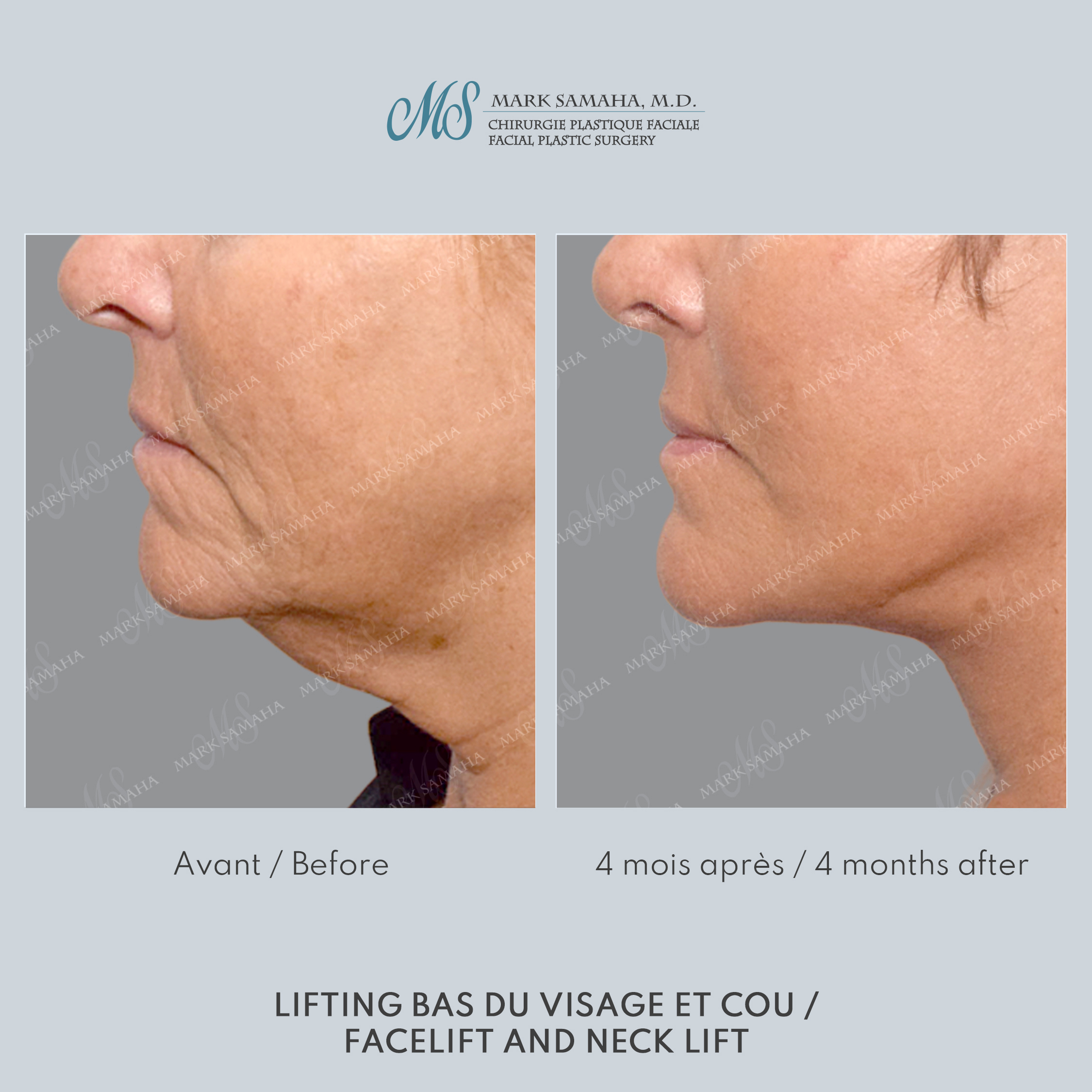 Before & After Lifting du visage / Cou - Facelift / Necklift Case 244 View #2 Detail View in Montreal, QC