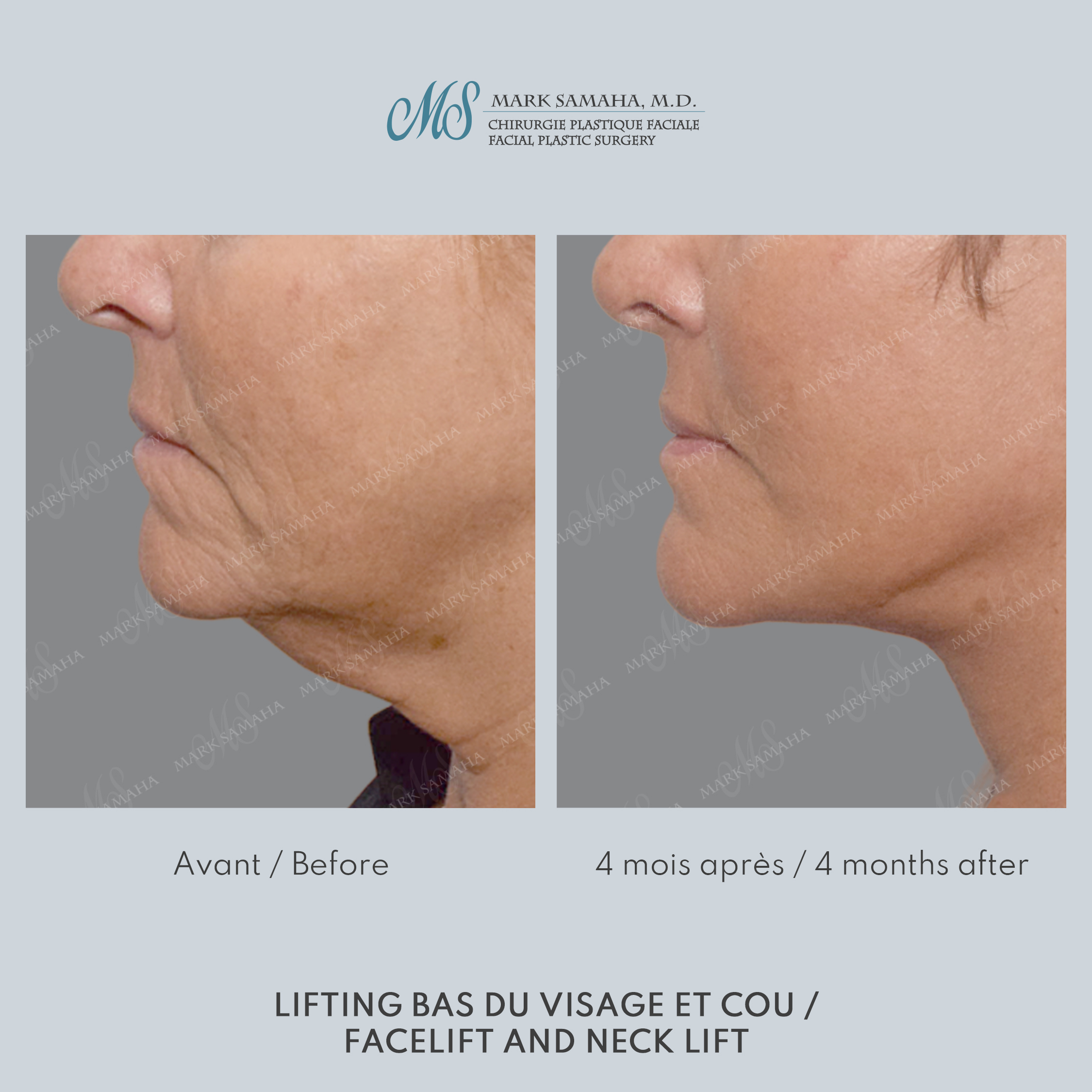 Before & After Lifting du visage / Cou - Facelift / Necklift Case 244 View #2 View in Montreal, QC