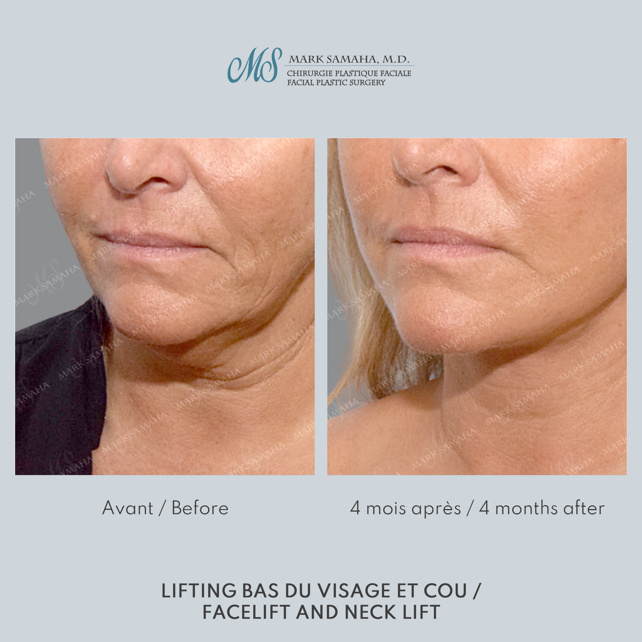 Before & After Lifting du visage / Cou - Facelift / Necklift Case 244 View #3 Detail View in Montreal, QC