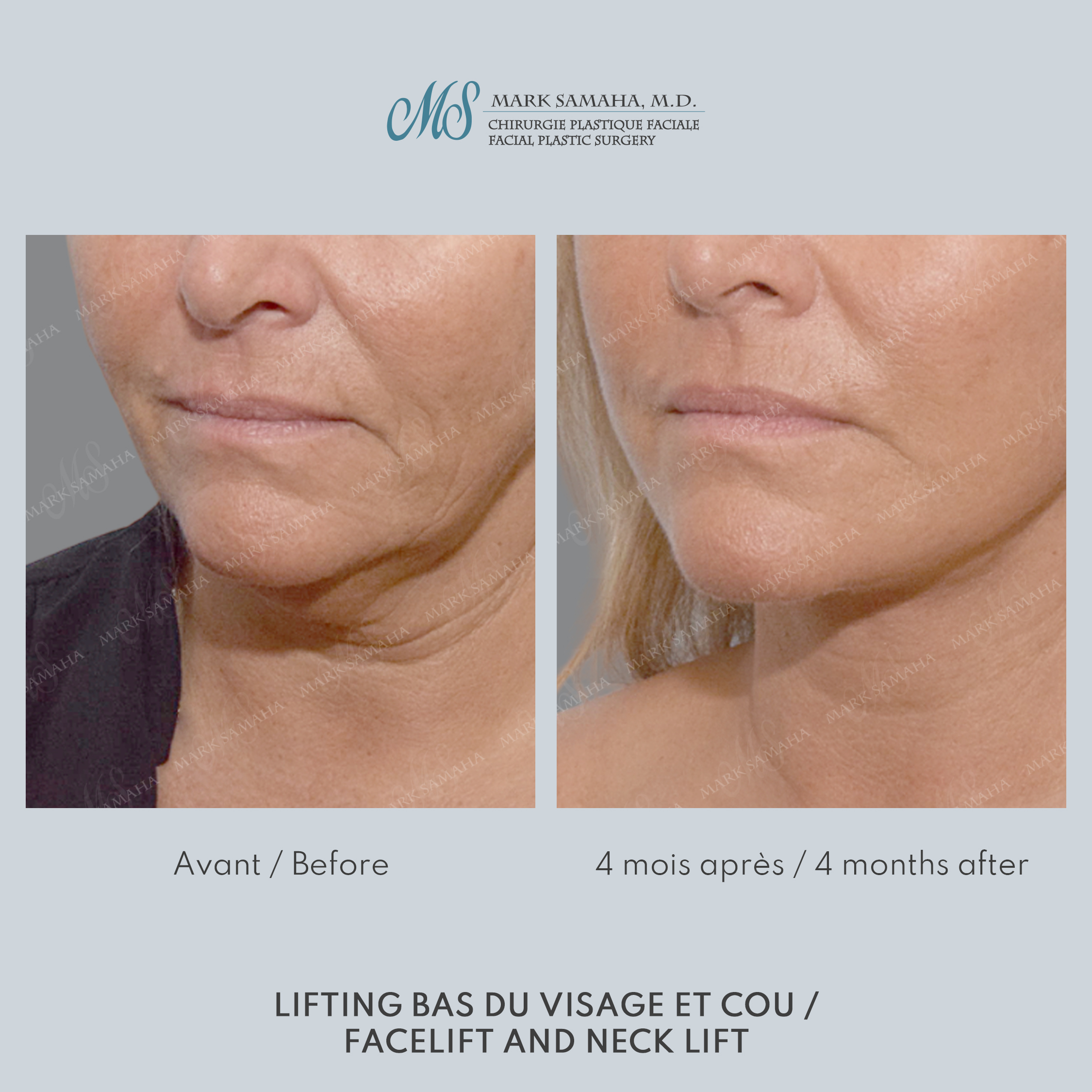 Before & After Lifting du visage / Cou - Facelift / Necklift Case 244 View #3 View in Montreal, QC