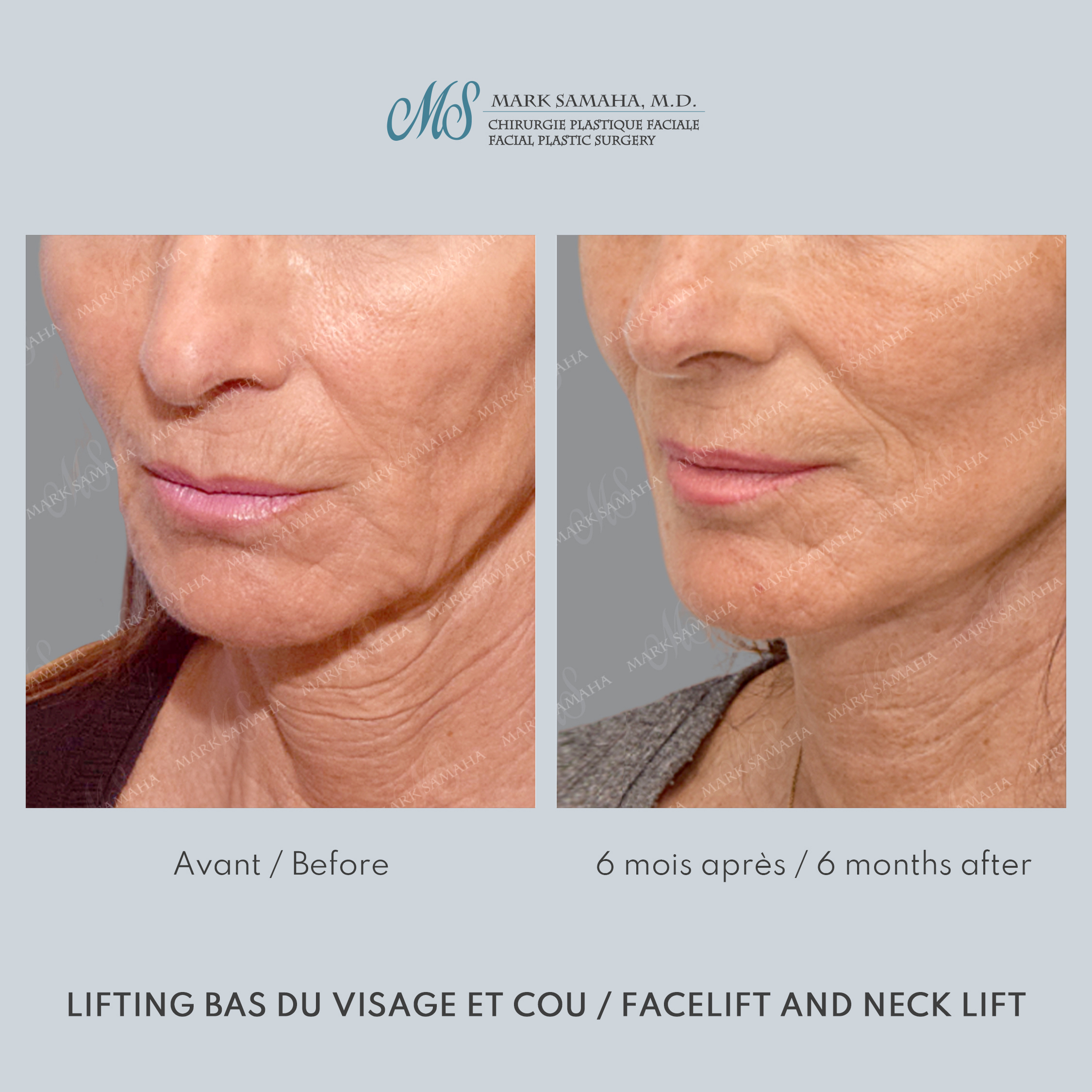 Before & After Lifting du visage / Cou - Facelift / Necklift Case 245 View #1 Detail View in Montreal, QC