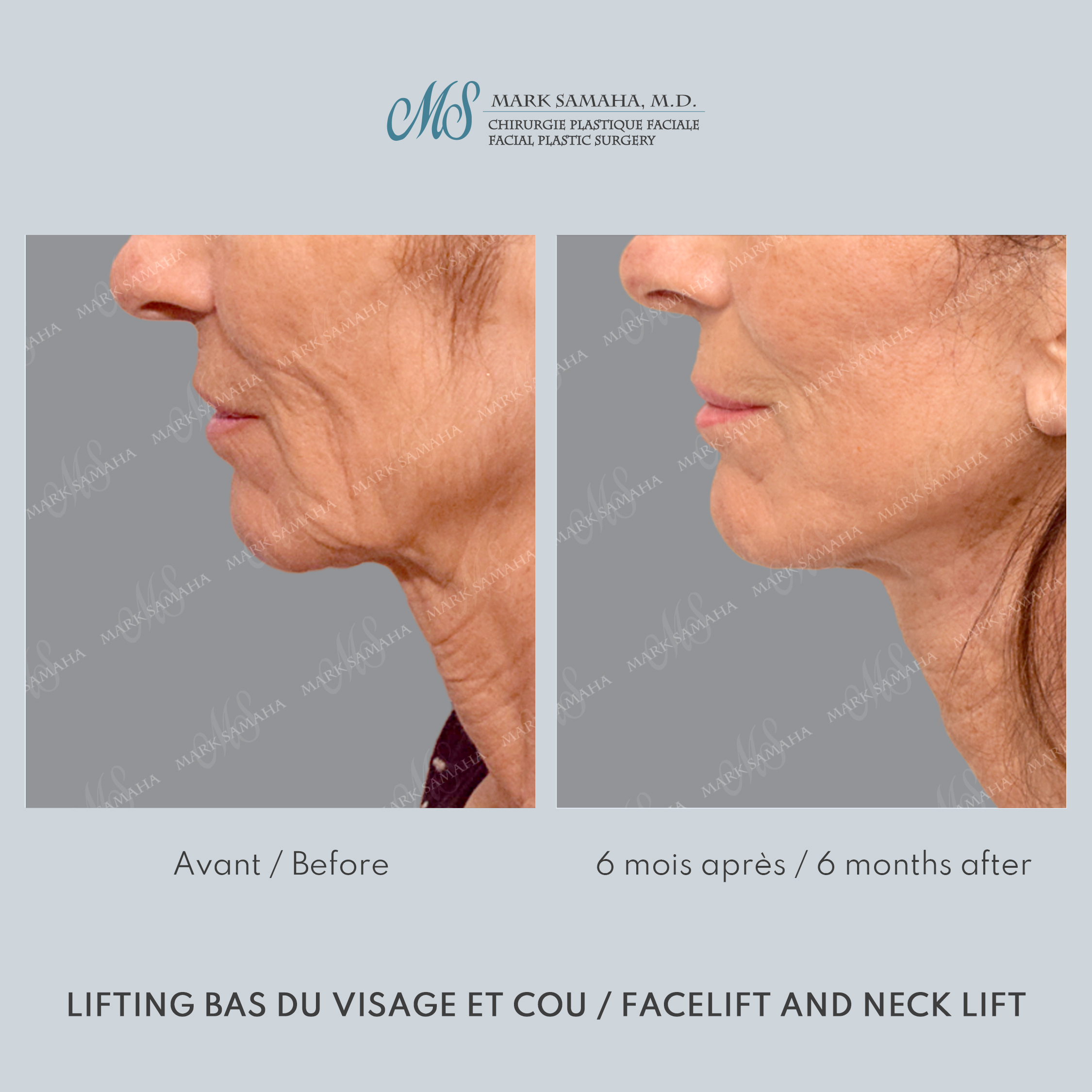 Before & After Lifting du visage / Cou - Facelift / Necklift Case 245 View #2 Detail View in Montreal, QC