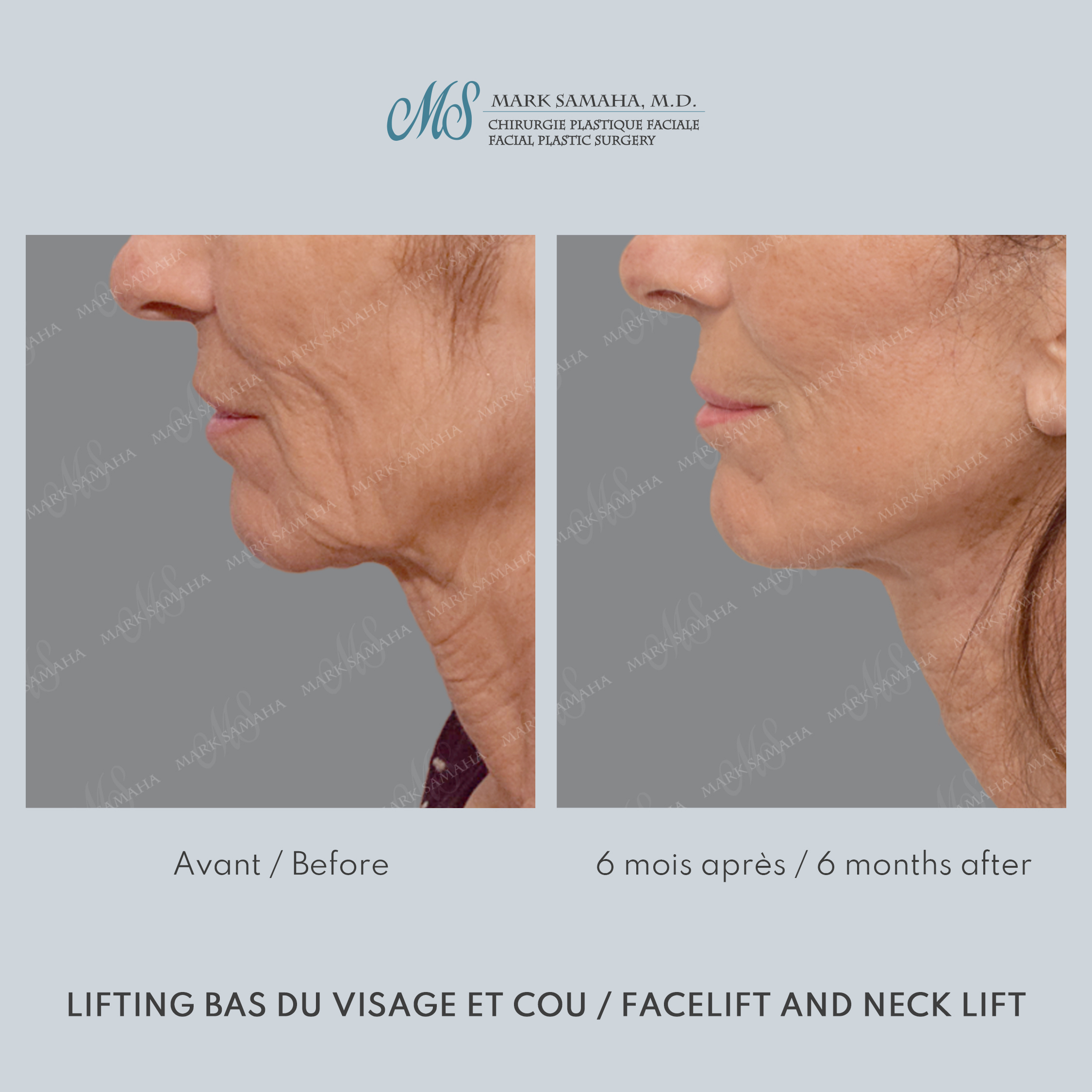 Before & After Lifting du visage / Cou - Facelift / Necklift Case 245 View #2 View in Montreal, QC