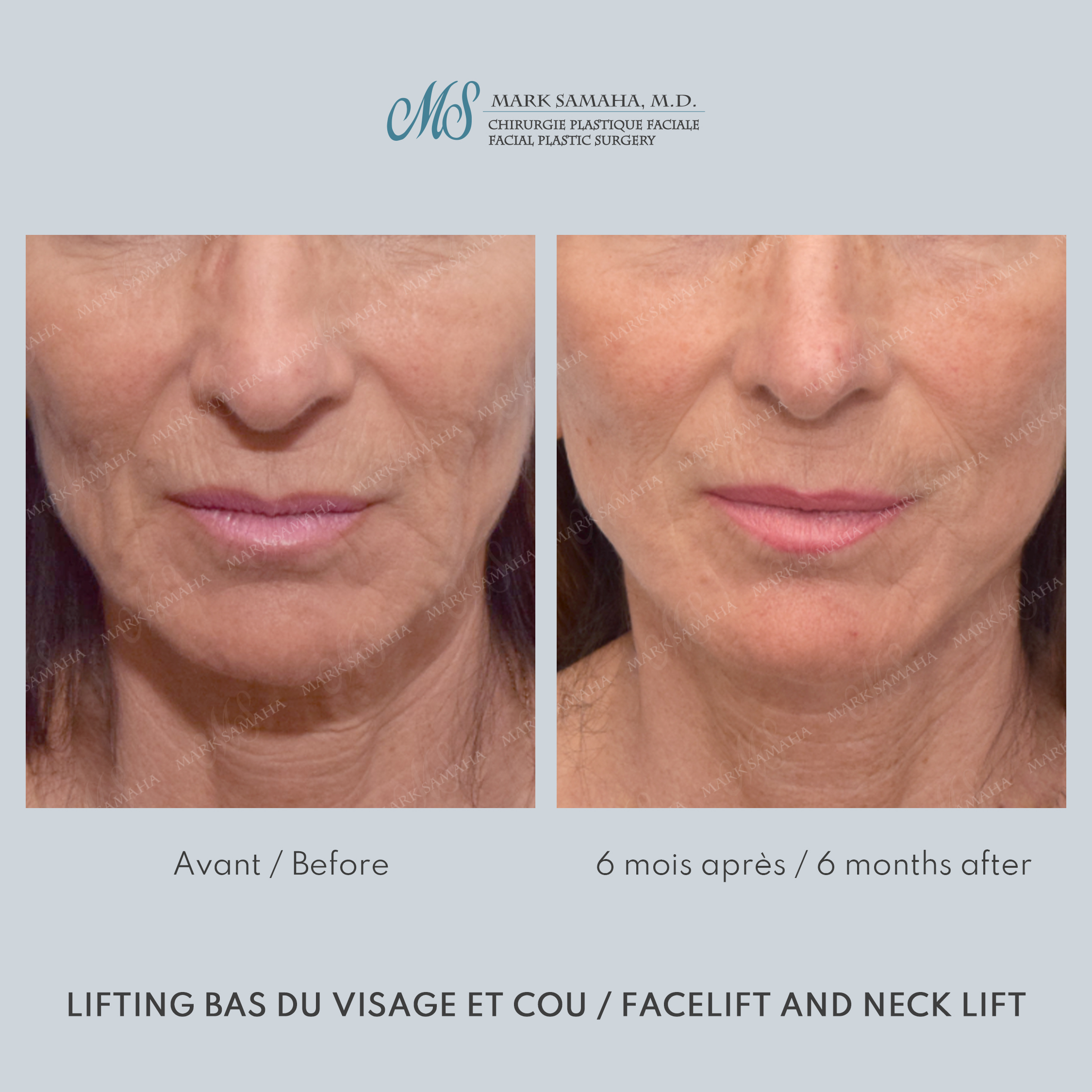 Before & After Lifting du visage / Cou - Facelift / Necklift Case 245 View #3 View in Montreal, QC