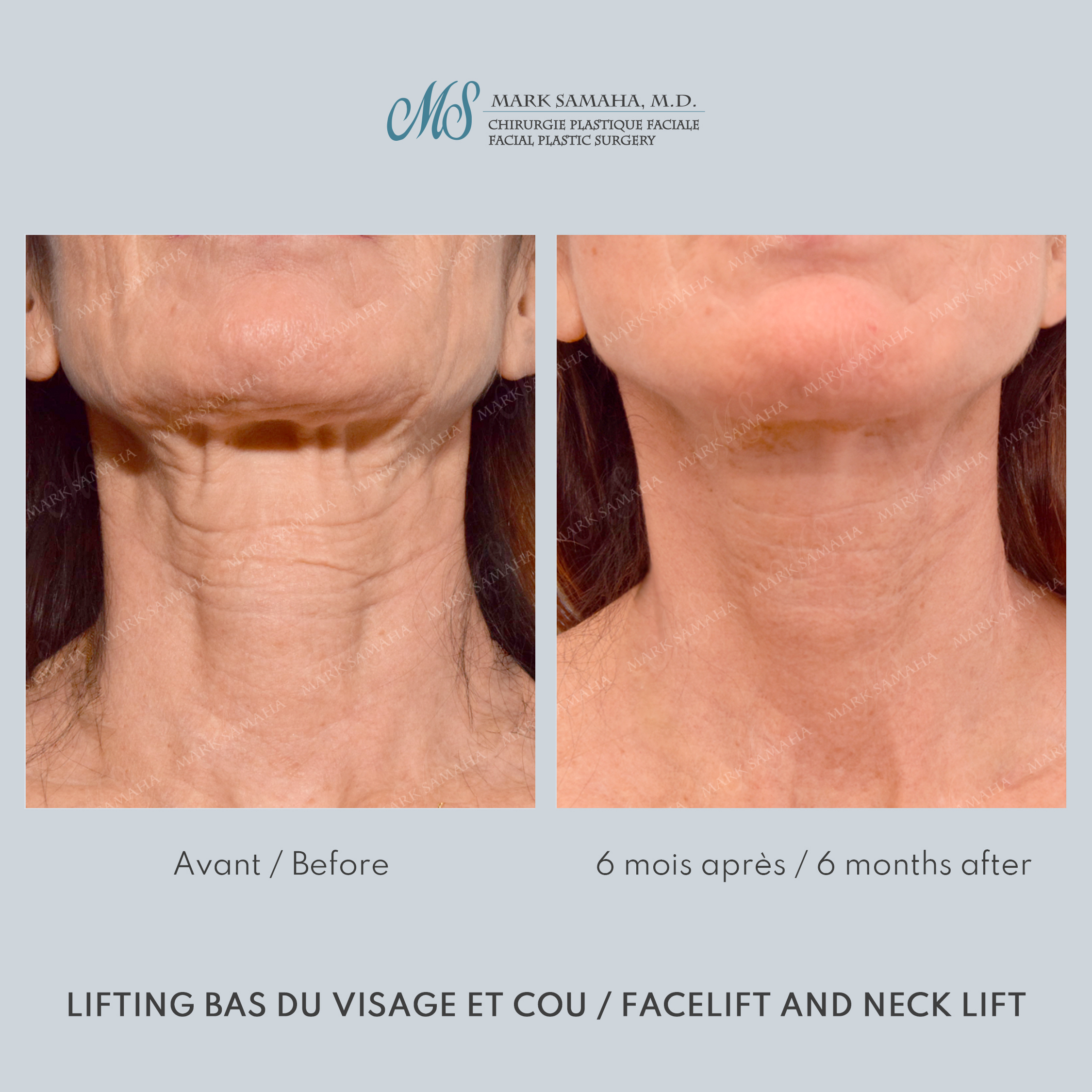 Before & After Lifting du visage / Cou - Facelift / Necklift Case 245 View #4 Detail View in Montreal, QC