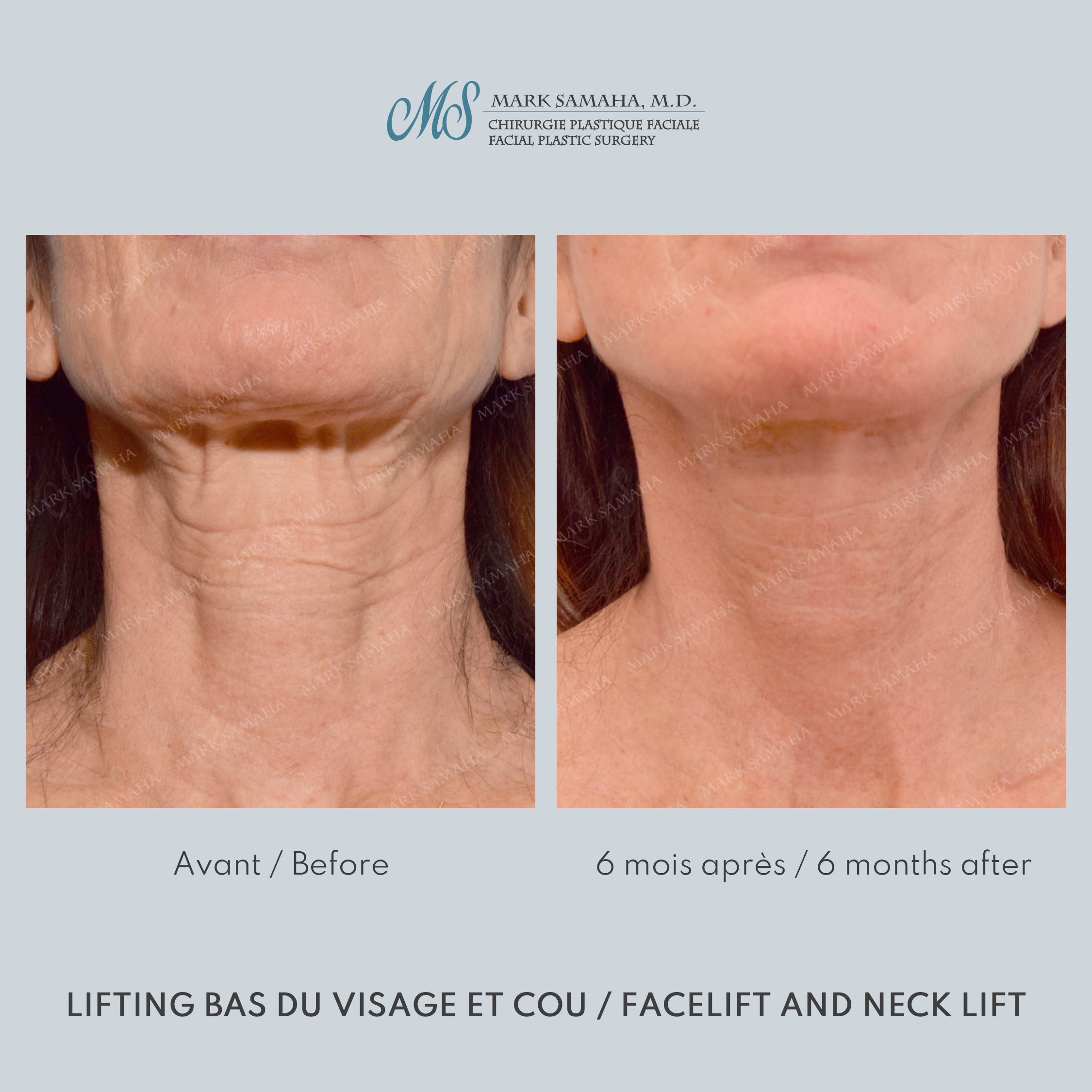 Before & After Lifting du visage / Cou - Facelift / Necklift Case 245 View #4 View in Montreal, QC