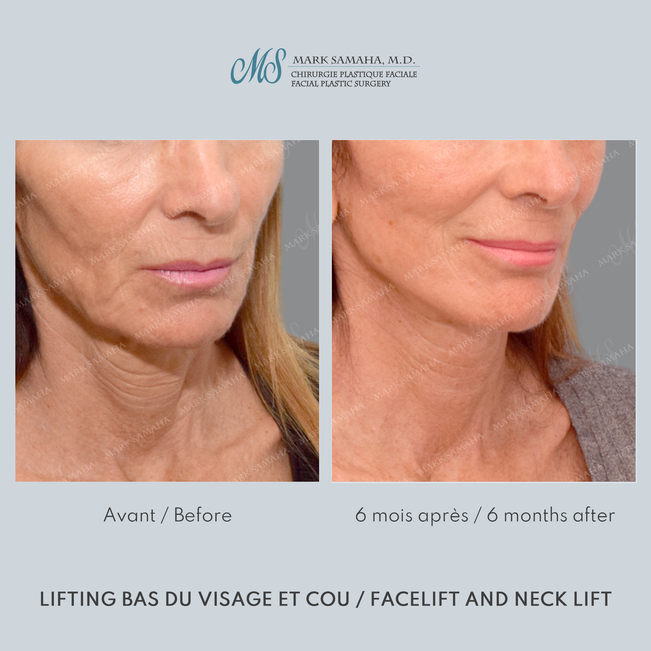 Before & After Lifting du visage / Cou - Facelift / Necklift Case 245 View #5 Detail View in Montreal, QC