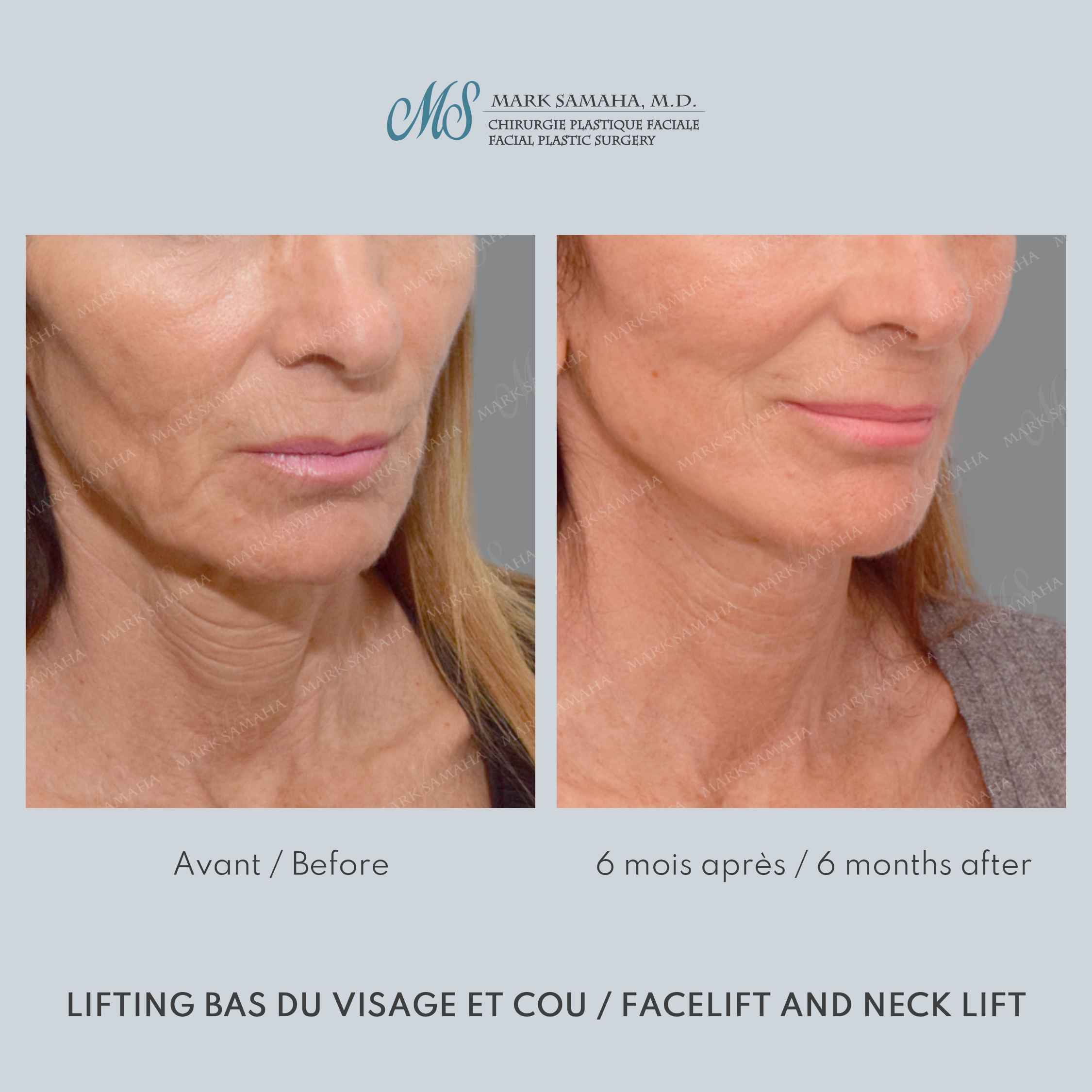 Before & After Lifting du visage / Cou - Facelift / Necklift Case 245 View #5 View in Montreal, QC