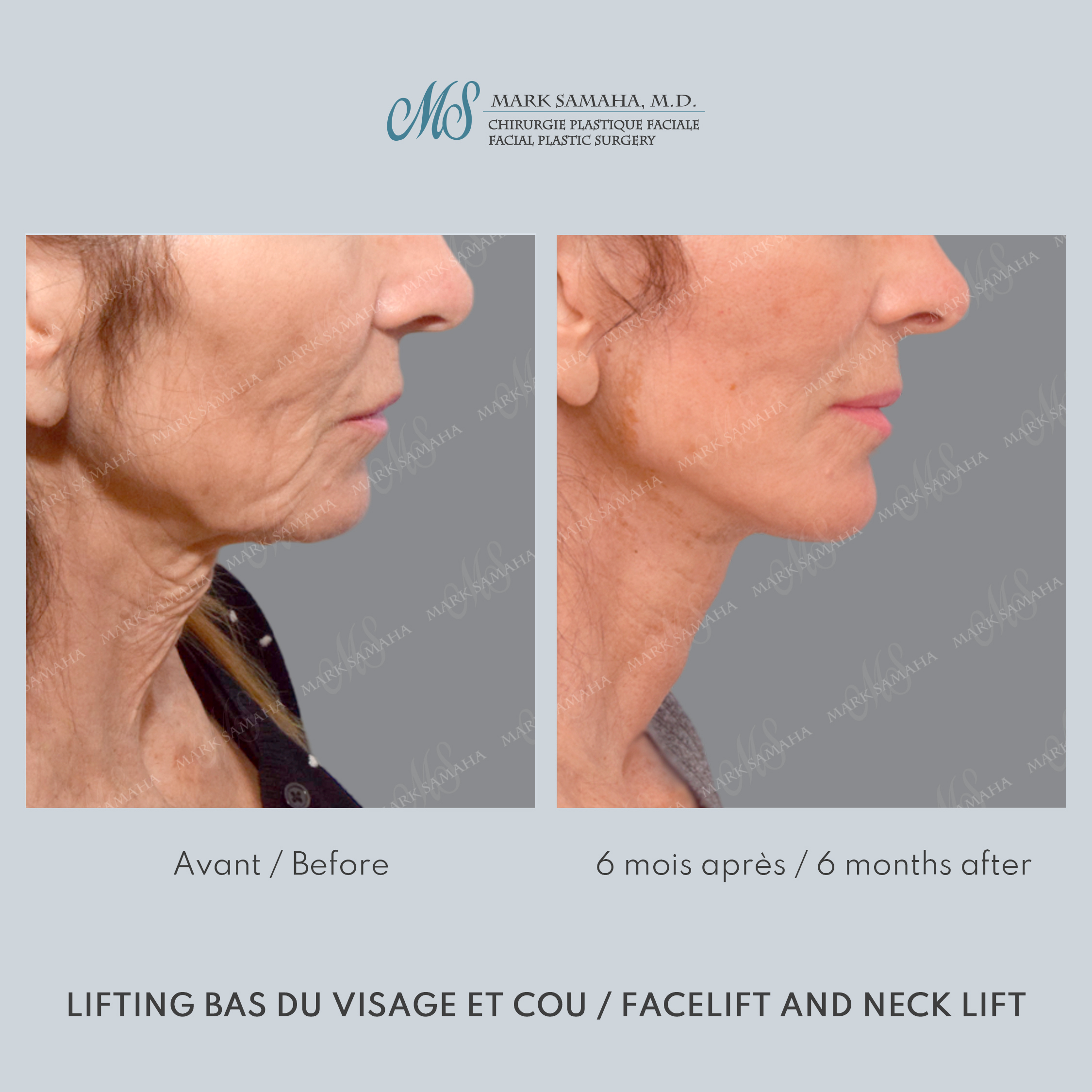 Before & After Lifting du visage / Cou - Facelift / Necklift Case 245 View #6 Detail View in Montreal, QC