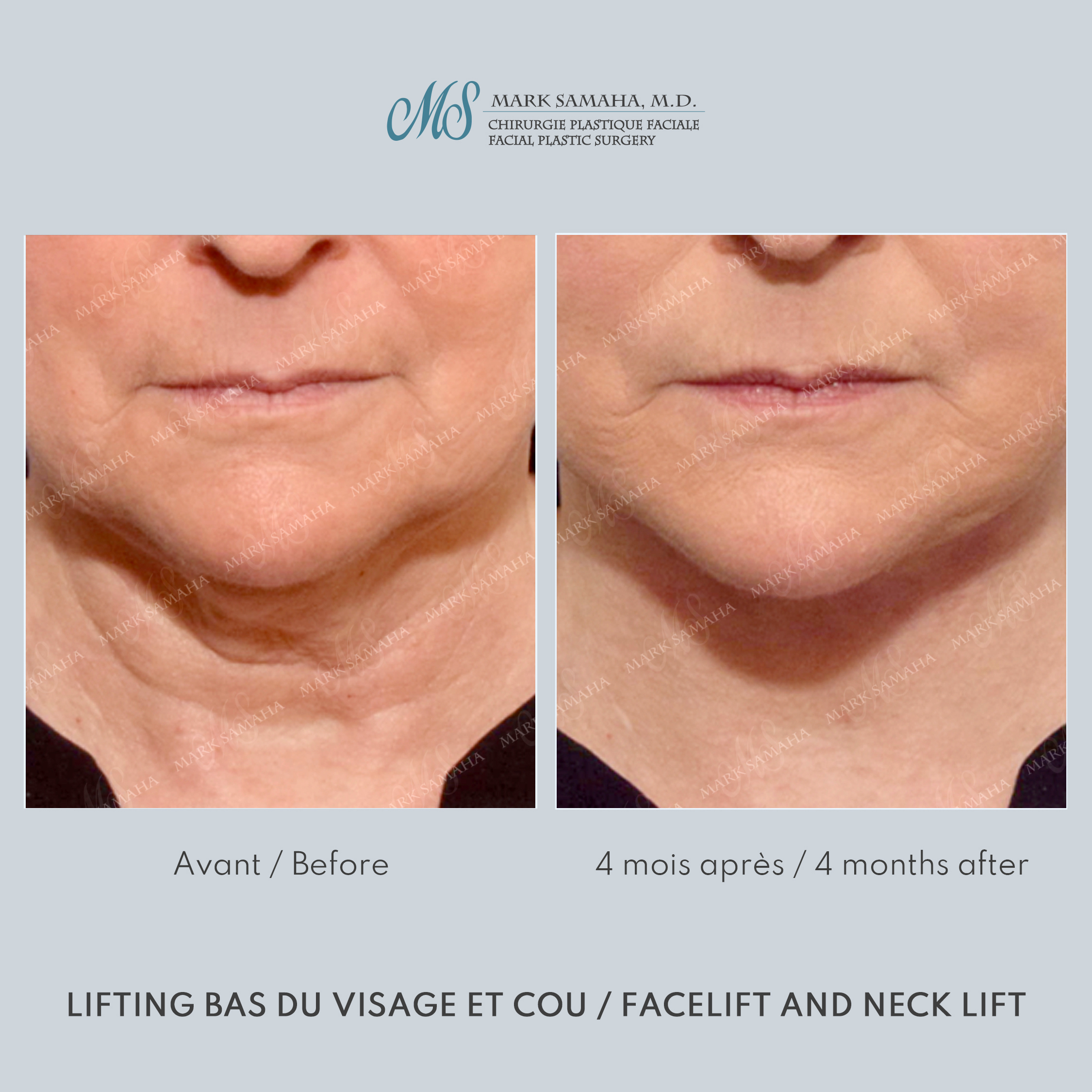 Before & After Lifting du visage / Cou - Facelift / Necklift Case 247 View #1 Detail View in Montreal, QC