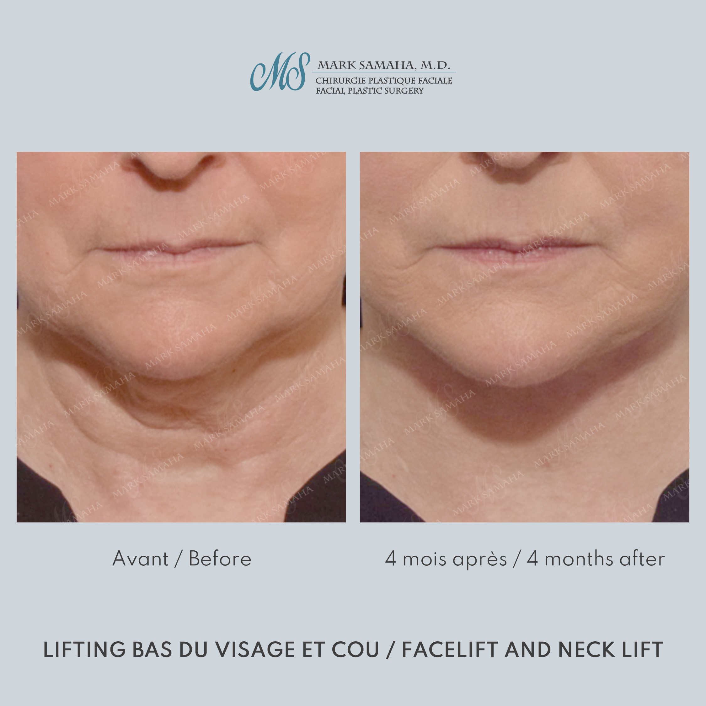 Before & After Lifting du visage / Cou - Facelift / Necklift Case 247 View #1 View in Montreal, QC