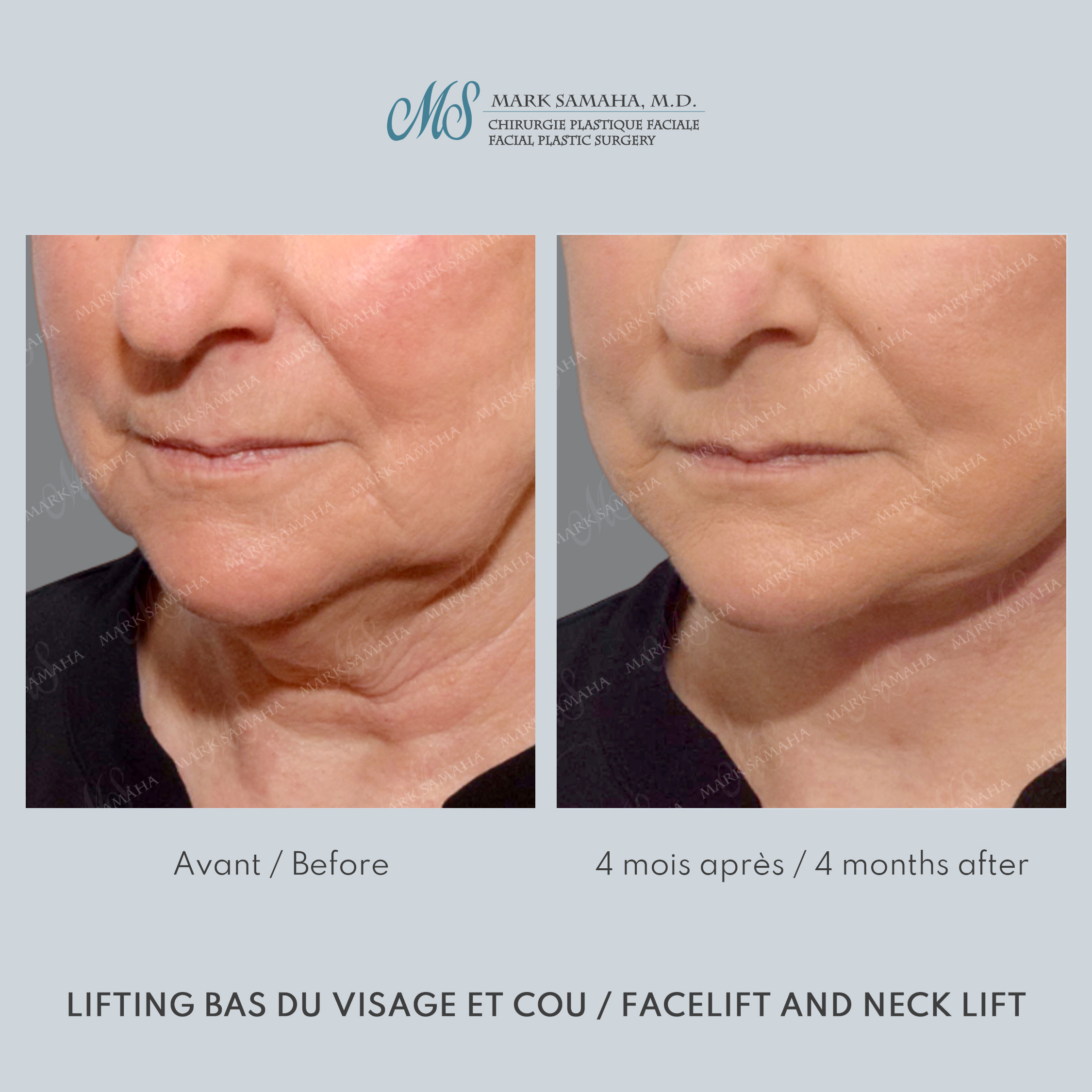 Before & After Lifting du visage / Cou - Facelift / Necklift Case 247 View #2 Detail View in Montreal, QC