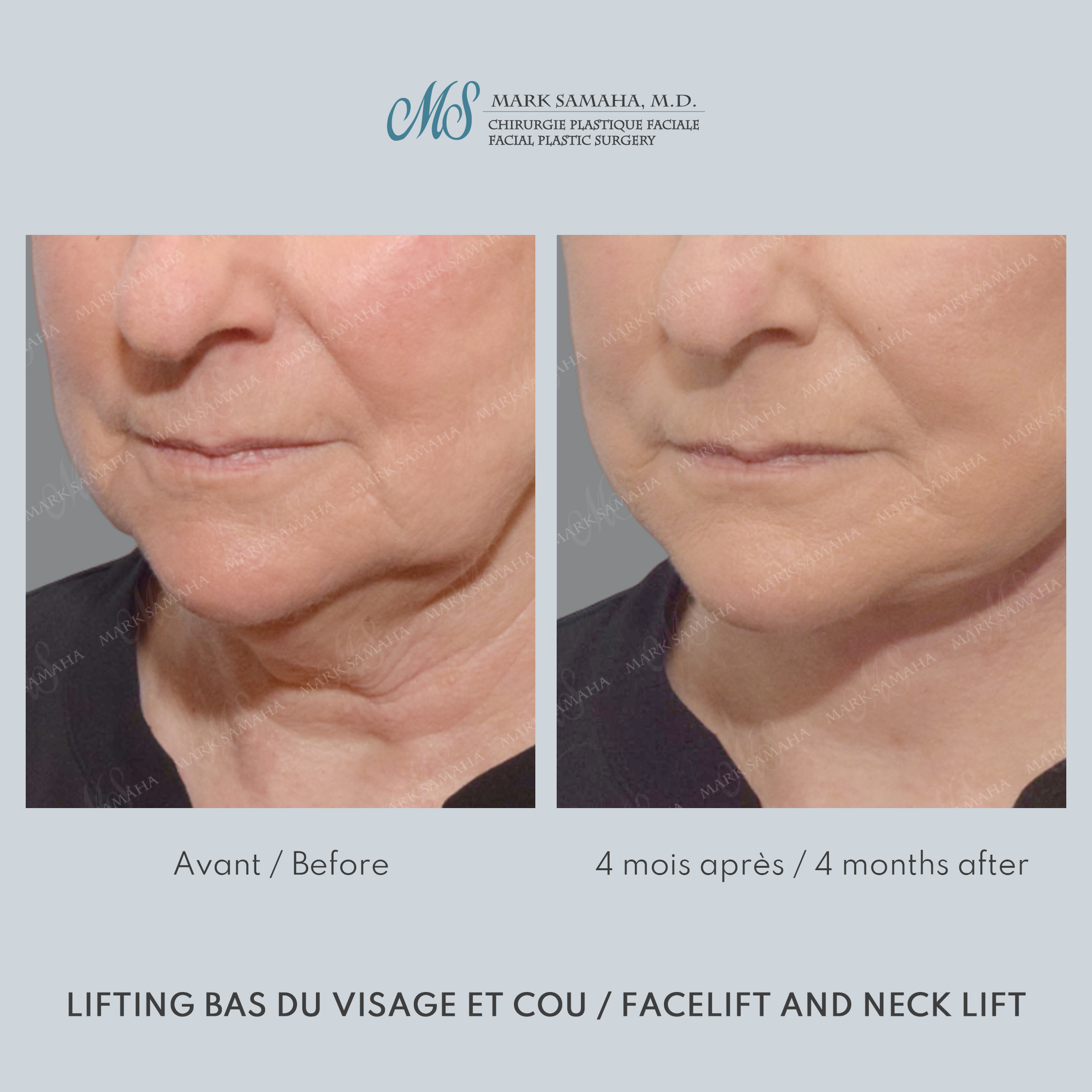 Before & After Lifting du visage / Cou - Facelift / Necklift Case 247 View #2 View in Montreal, QC