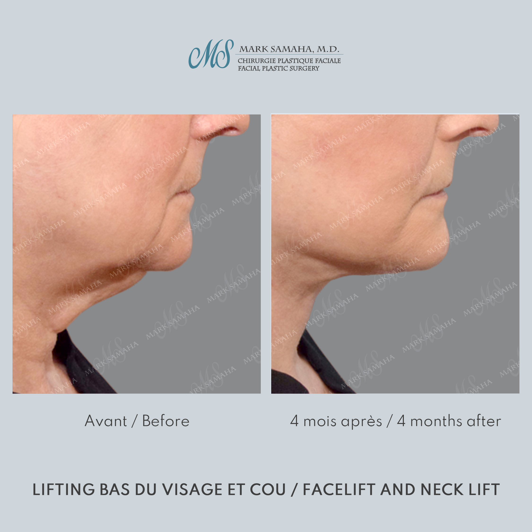 Before & After Lifting du visage / Cou - Facelift / Necklift Case 247 View #3 Detail View in Montreal, QC