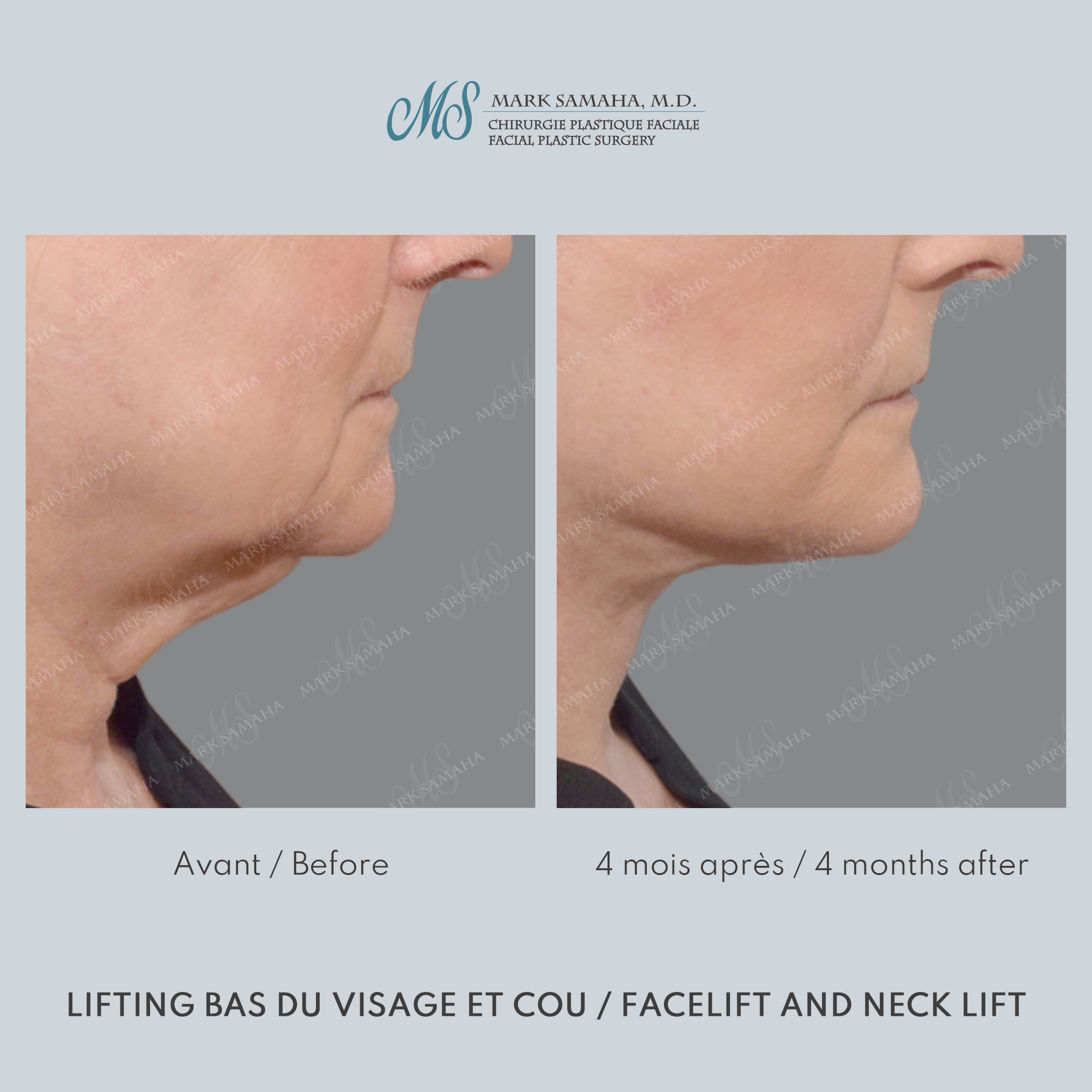 Before & After Lifting du visage / Cou - Facelift / Necklift Case 247 View #3 View in Montreal, QC