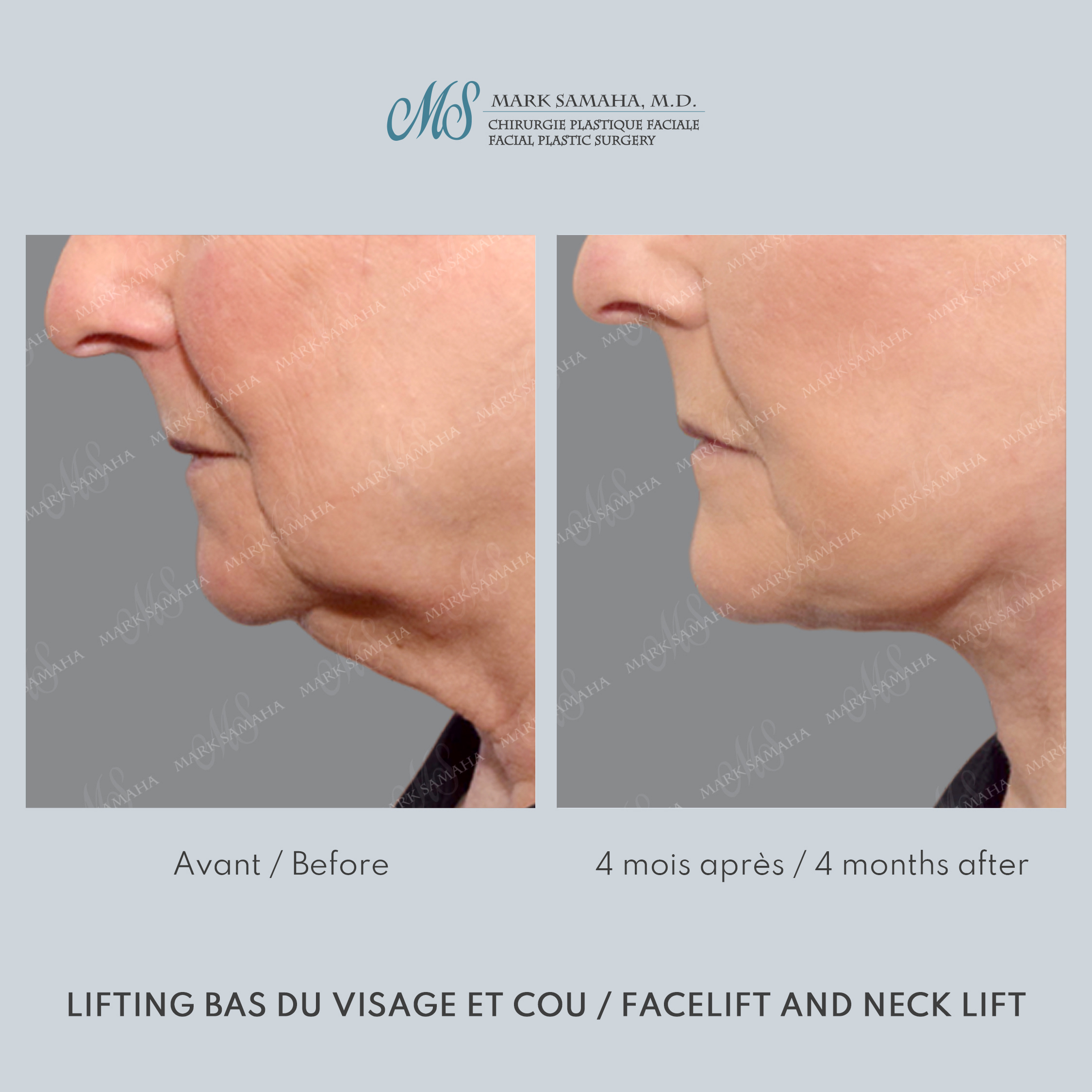 Before & After Lifting du visage / Cou - Facelift / Necklift Case 247 View #4 Detail View in Montreal, QC