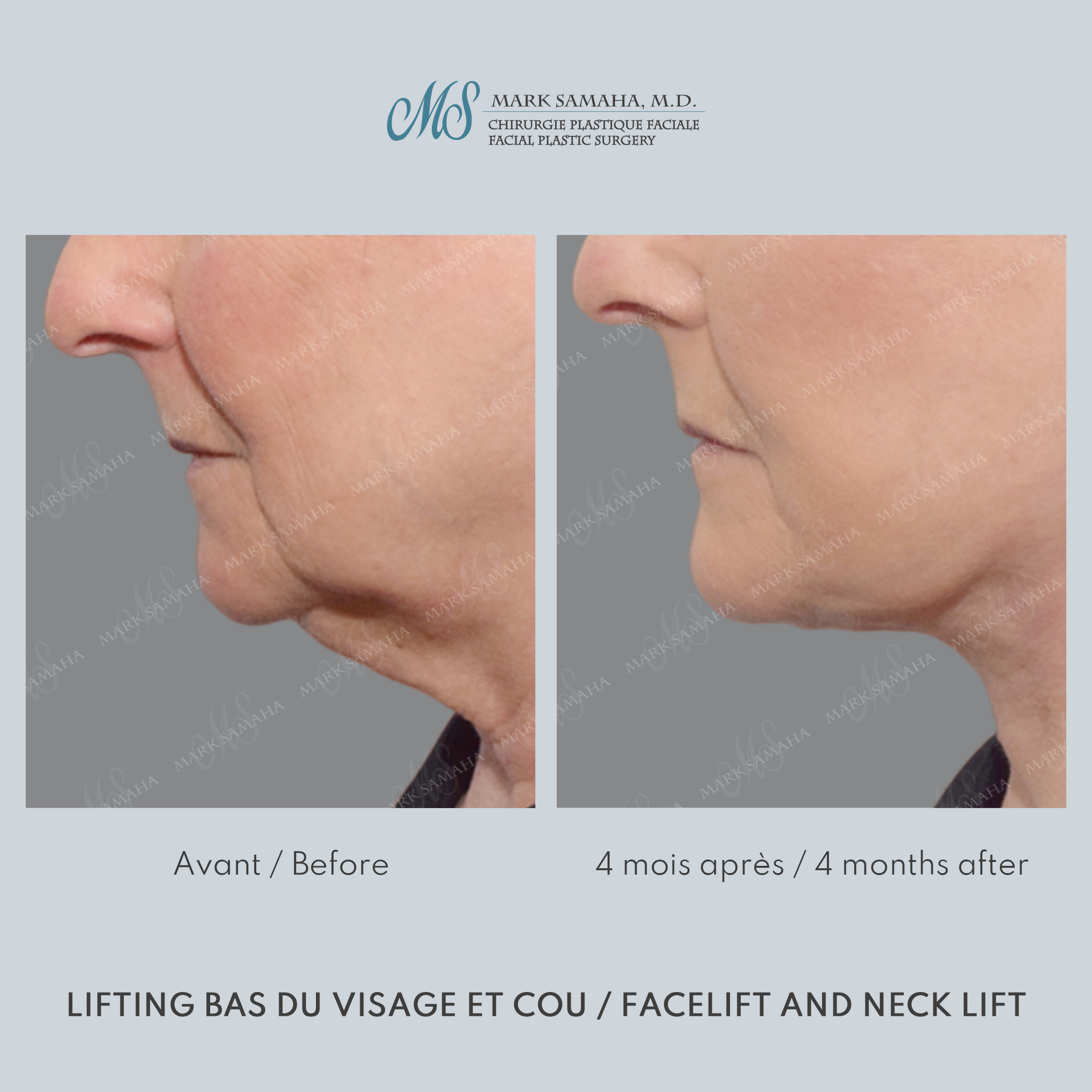 Before & After Lifting du visage / Cou - Facelift / Necklift Case 247 View #4 View in Montreal, QC