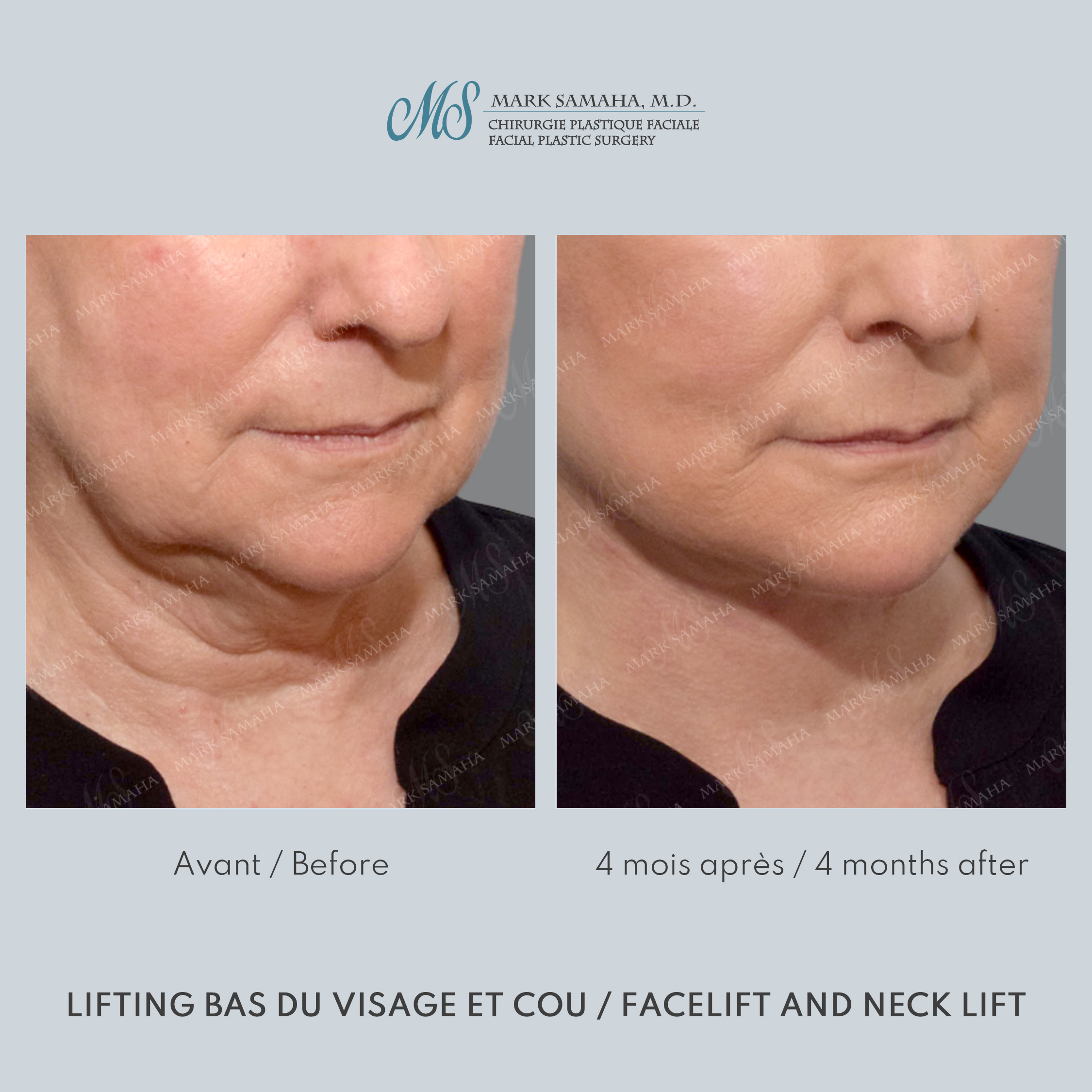 Before & After Lifting du visage / Cou - Facelift / Necklift Case 247 View #5 Detail View in Montreal, QC
