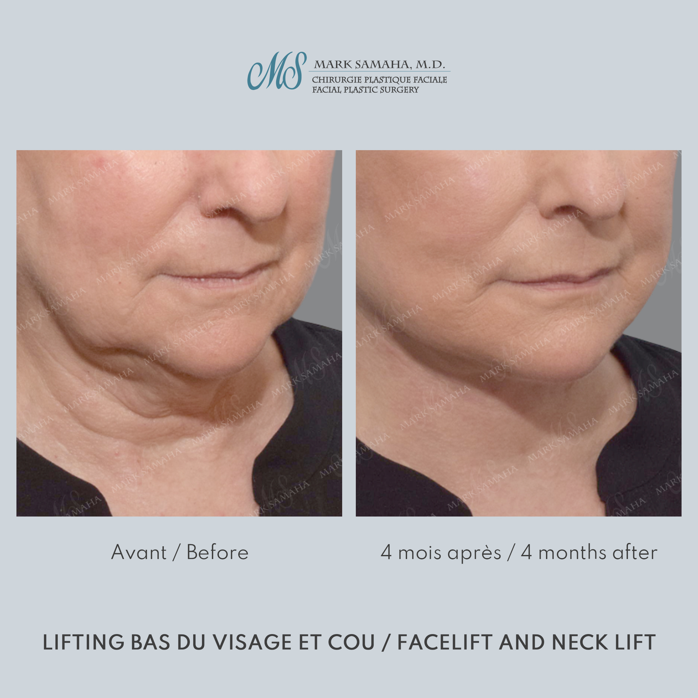 Before & After Lifting du visage / Cou - Facelift / Necklift Case 247 View #5 View in Montreal, QC