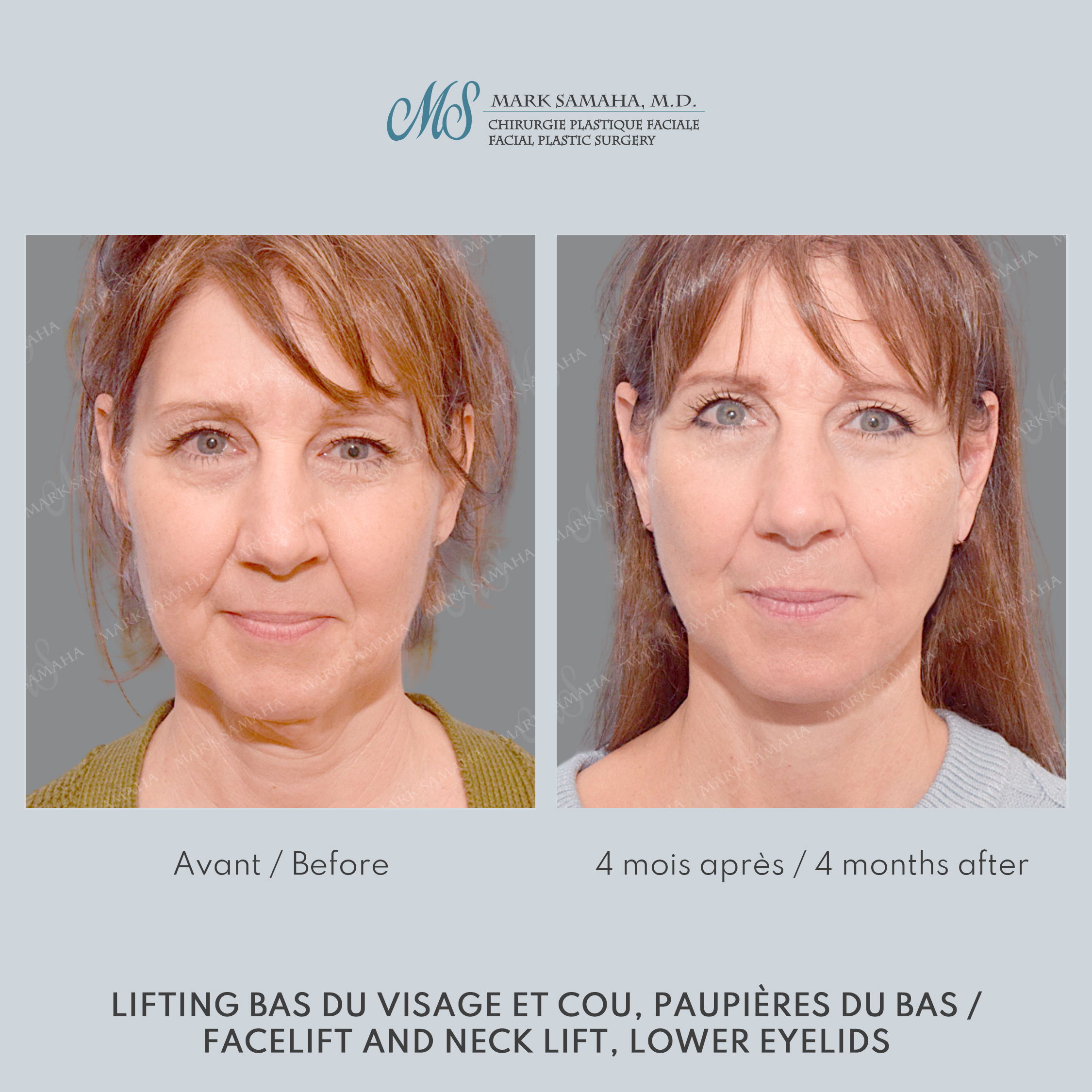 Before & After Lifting du visage / Cou - Facelift / Necklift Case 248 View #1 Detail View in Montreal, QC