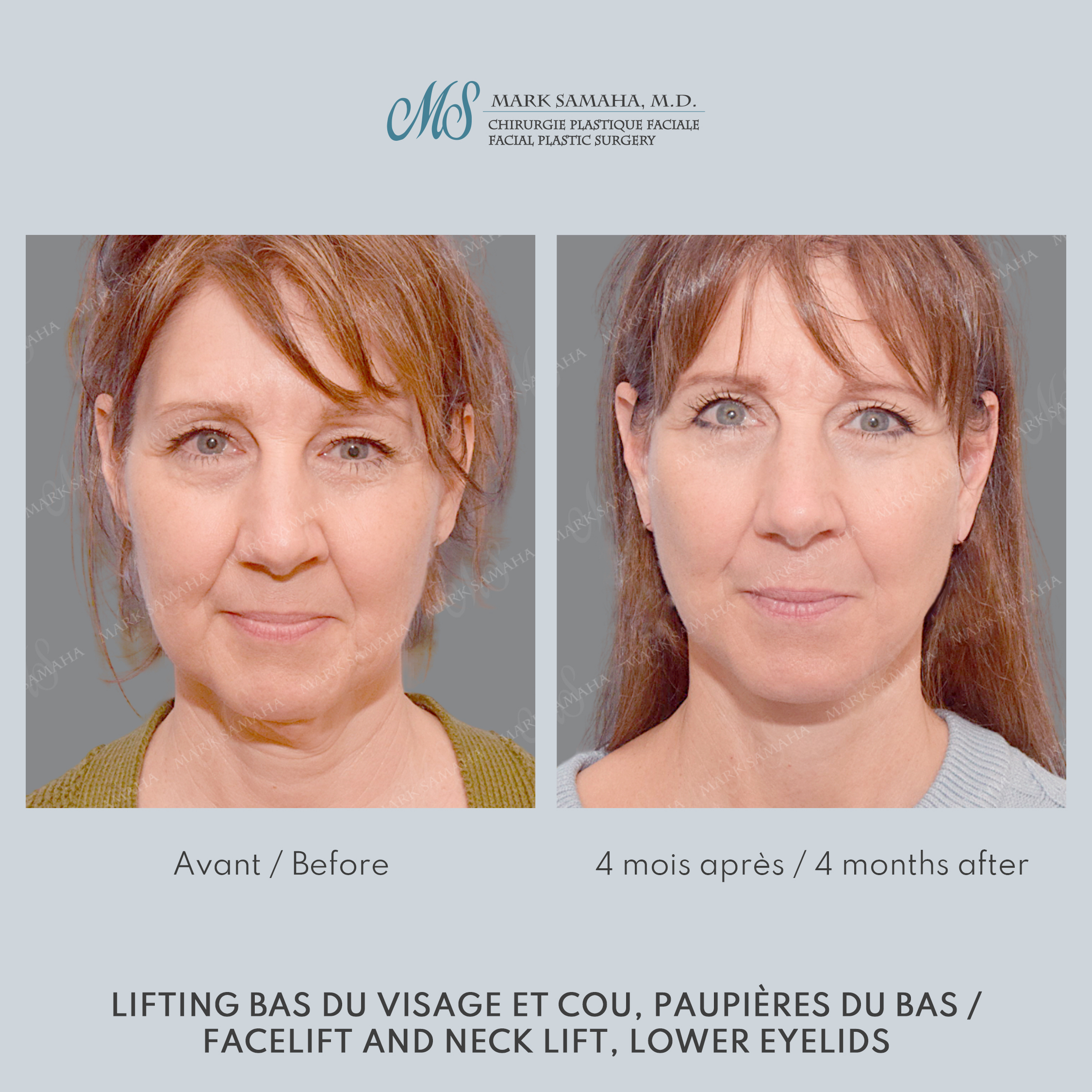 Before & After Lifting du visage / Cou - Facelift / Necklift Case 248 View #1 View in Montreal, QC