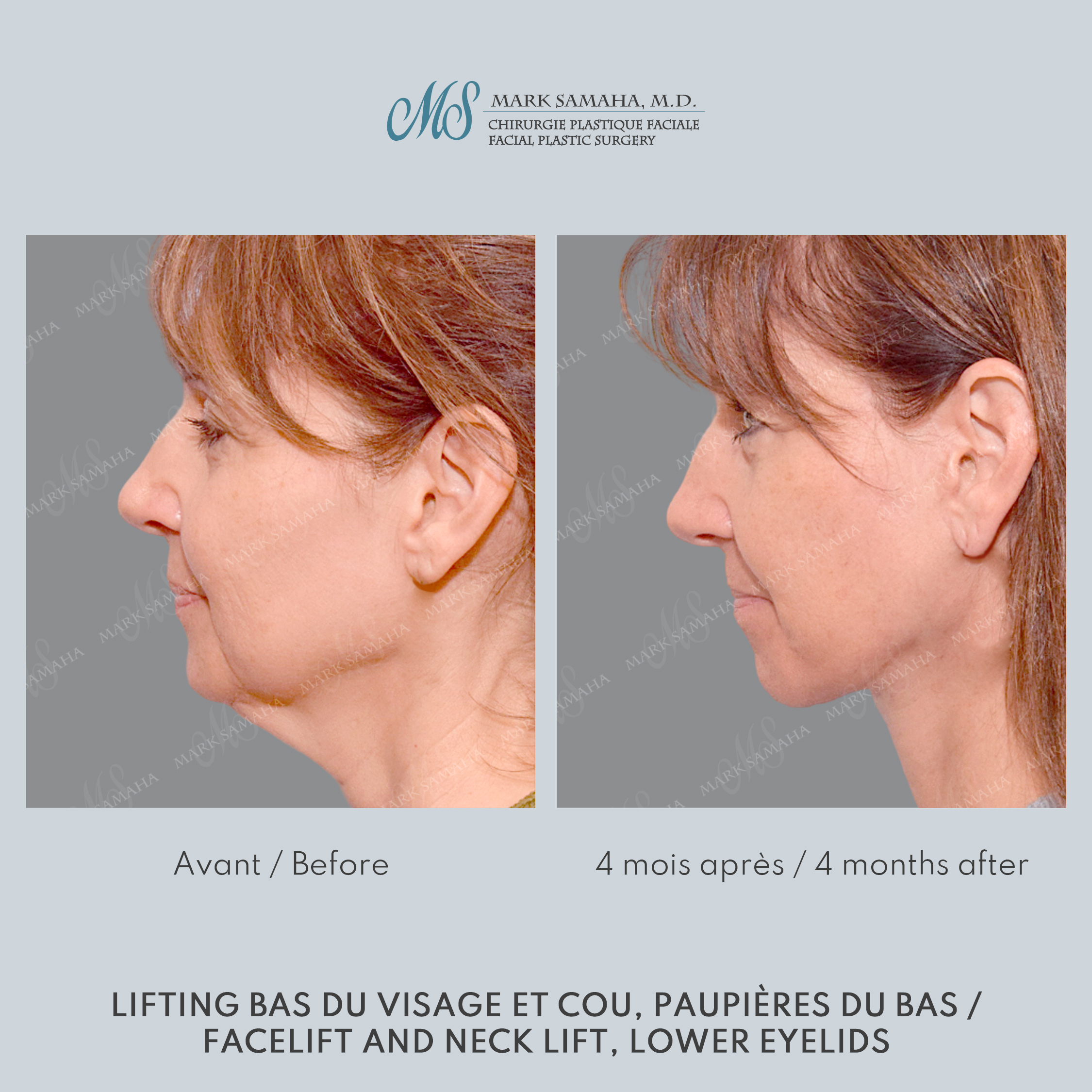 Before & After Lifting du visage / Cou - Facelift / Necklift Case 248 View #2 Detail View in Montreal, QC