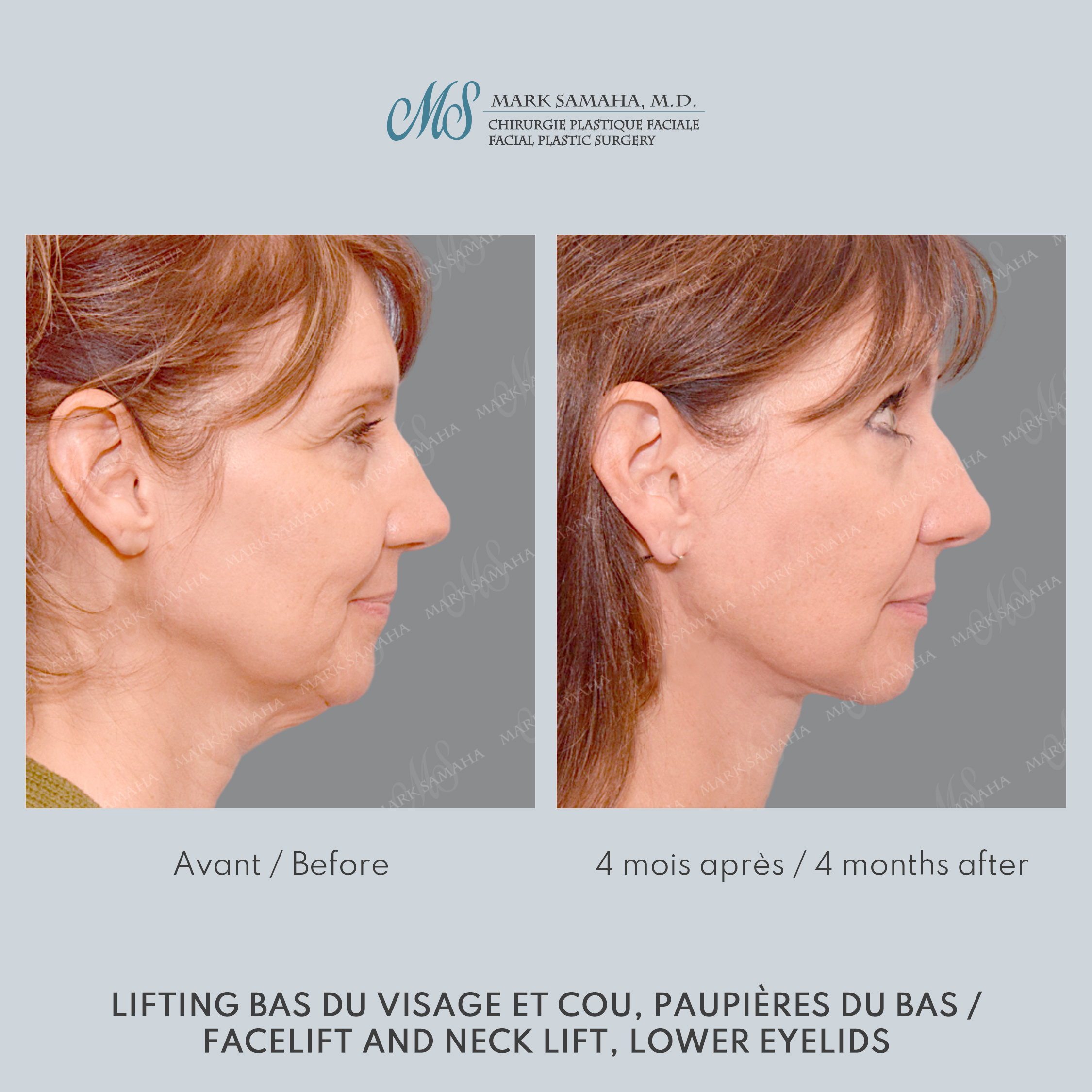 Before & After Lifting du visage / Cou - Facelift / Necklift Case 248 View #3 Detail View in Montreal, QC