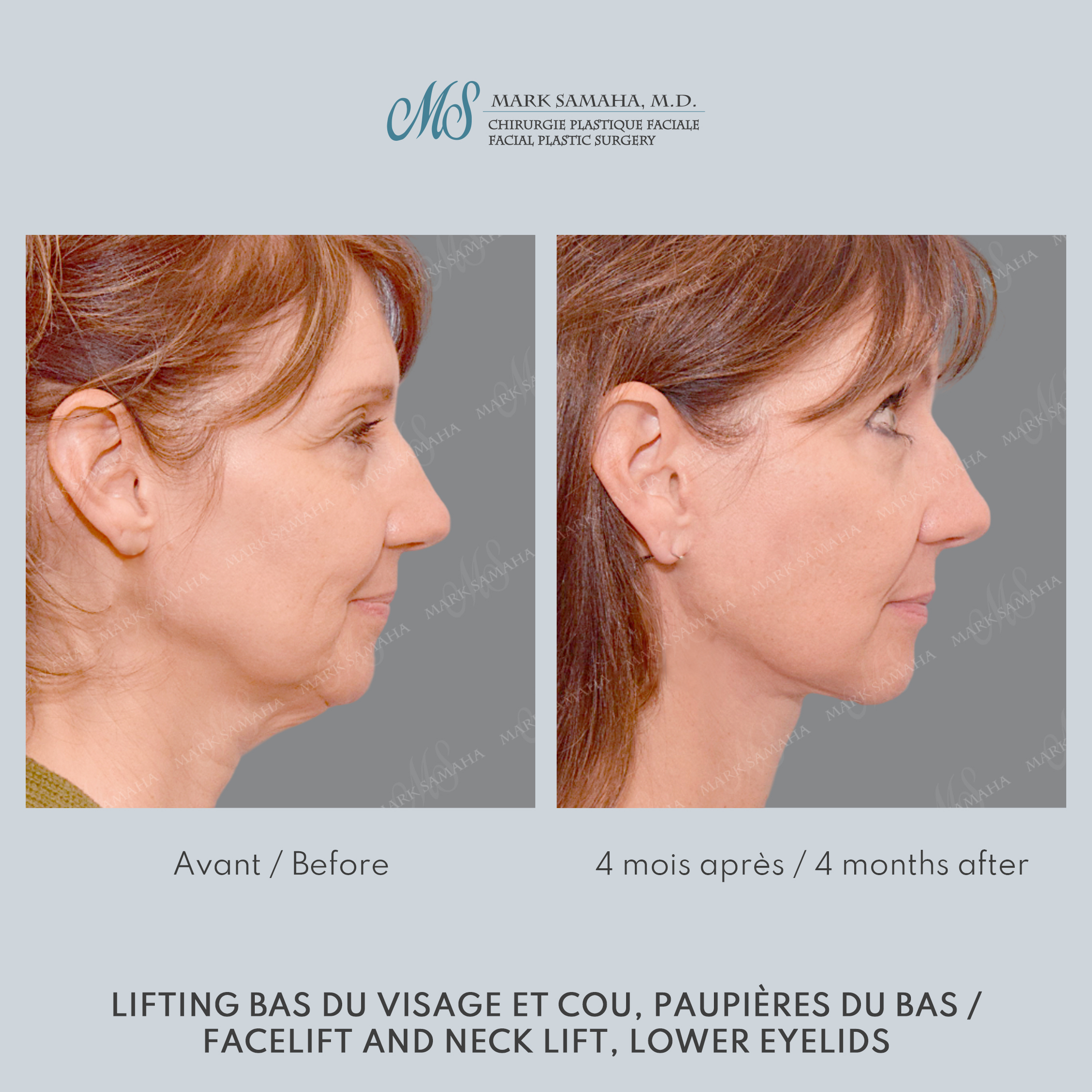 Before & After Lifting du visage / Cou - Facelift / Necklift Case 248 View #3 View in Montreal, QC