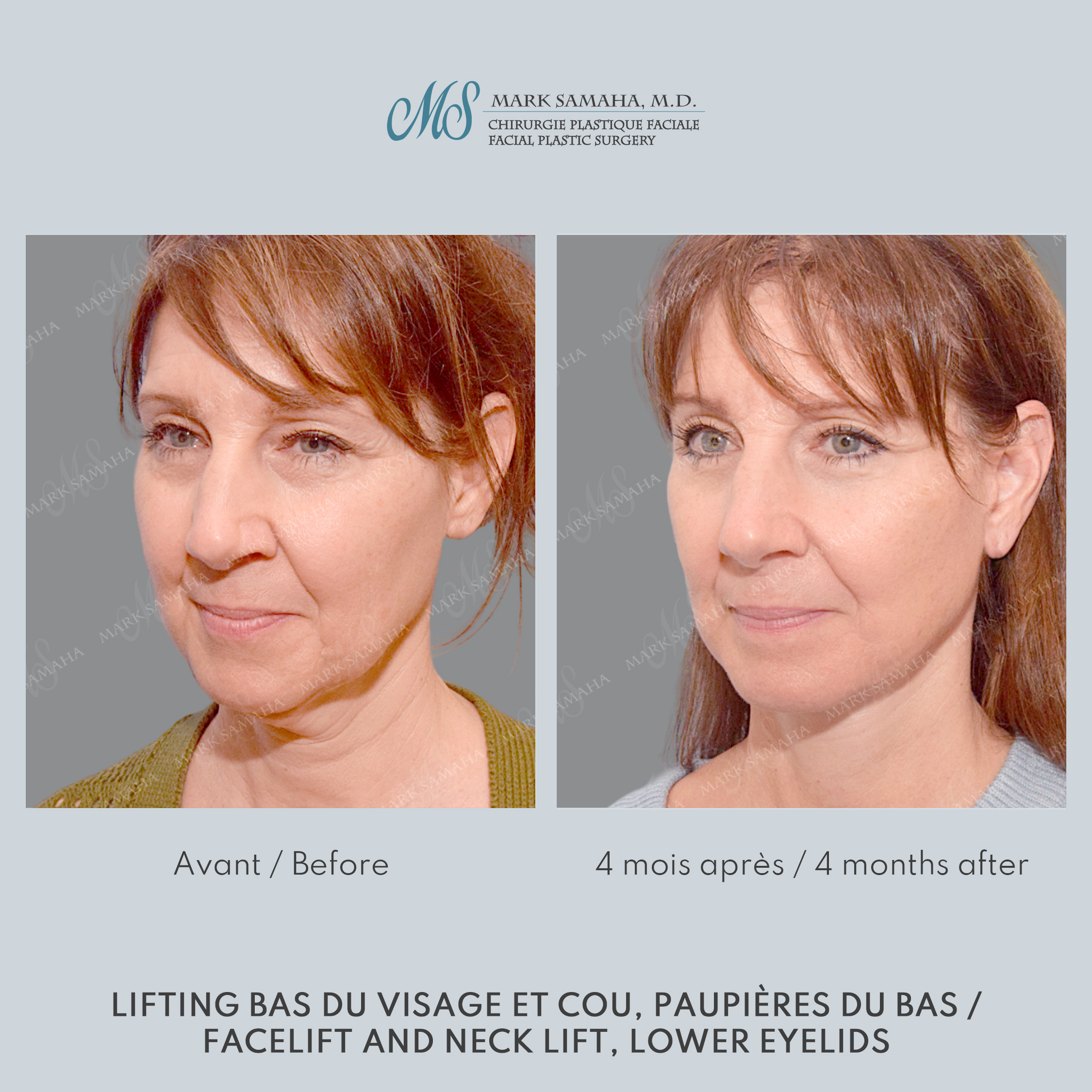 Before & After Lifting du visage / Cou - Facelift / Necklift Case 248 View #4 Detail View in Montreal, QC