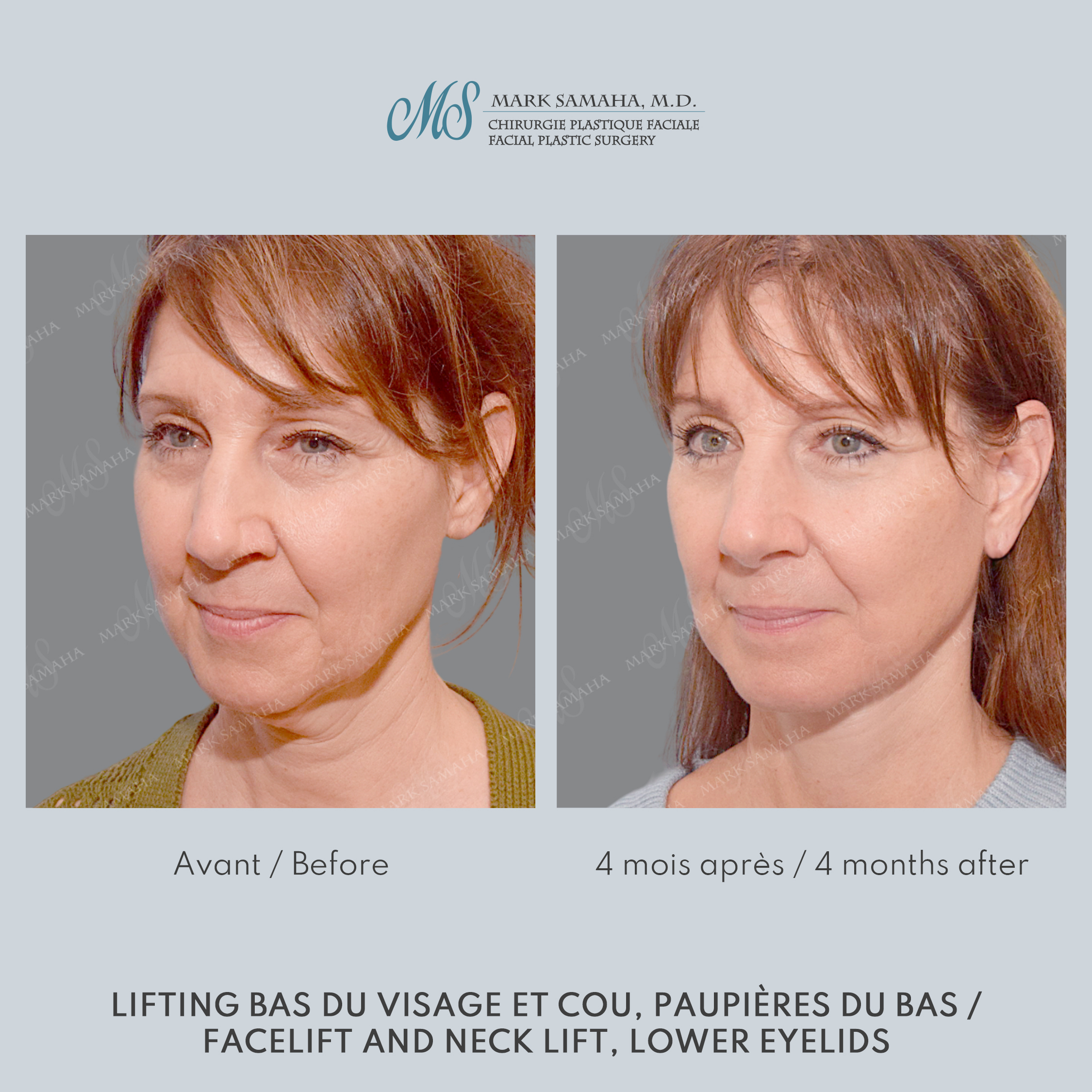 Before & After Lifting du visage / Cou - Facelift / Necklift Case 248 View #4 View in Montreal, QC