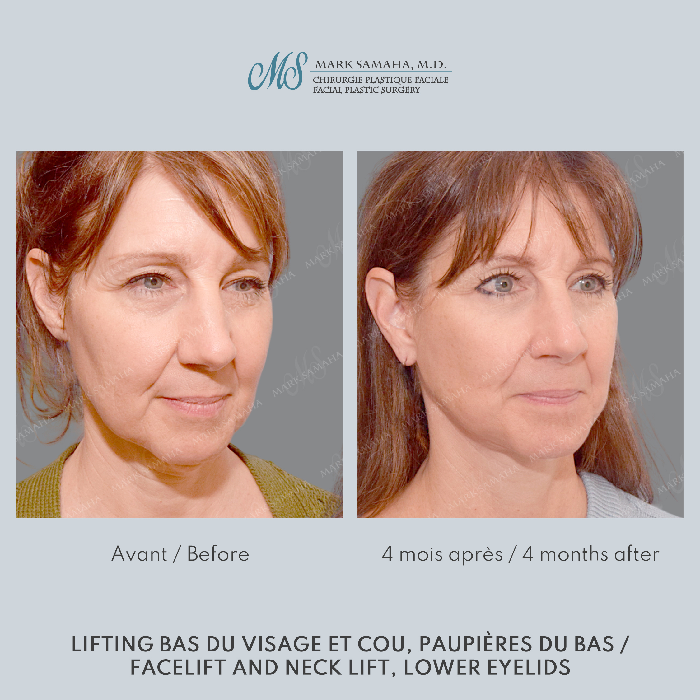 Before & After Lifting du visage / Cou - Facelift / Necklift Case 248 View #5 Detail View in Montreal, QC