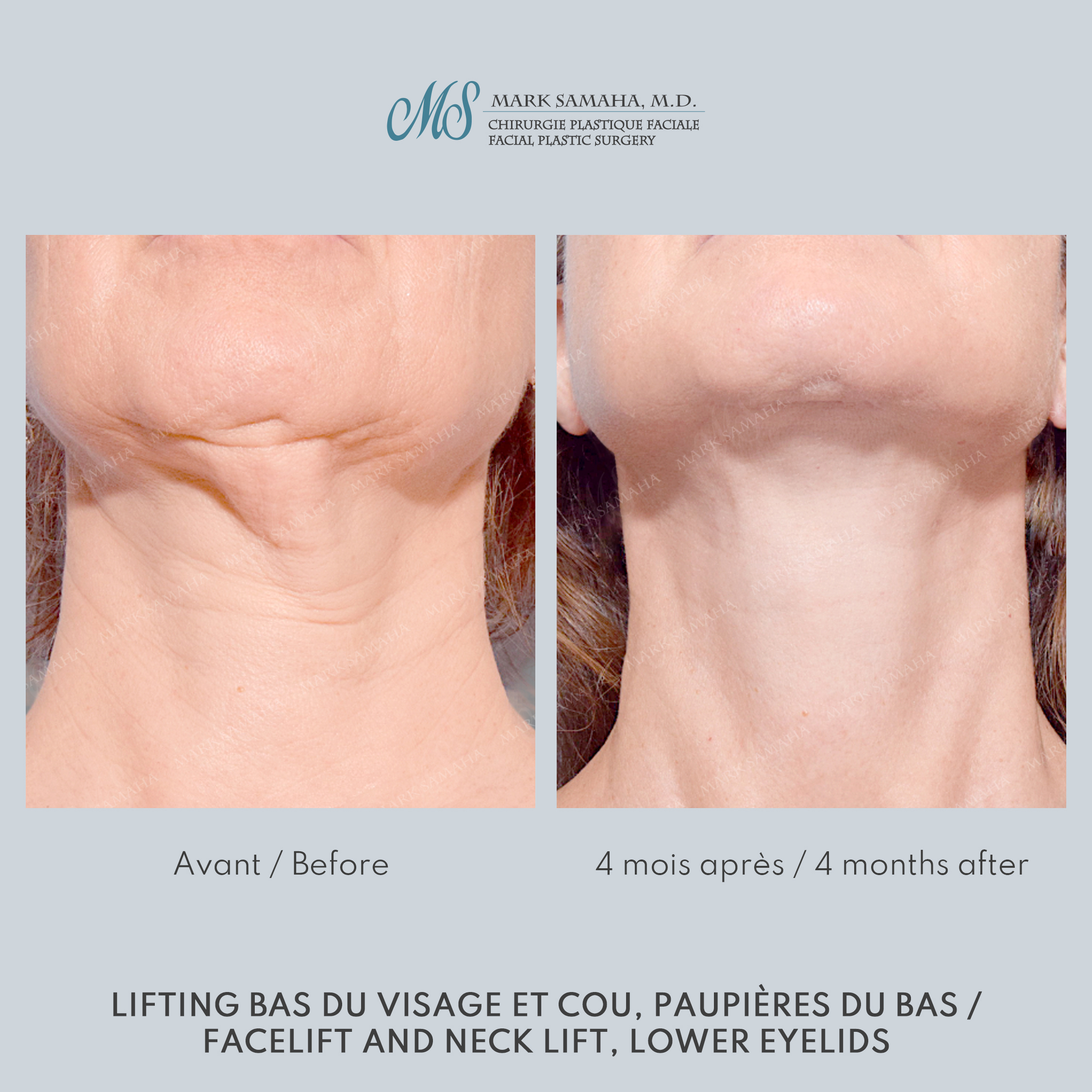 Before & After Lifting du visage / Cou - Facelift / Necklift Case 248 View #6 Detail View in Montreal, QC