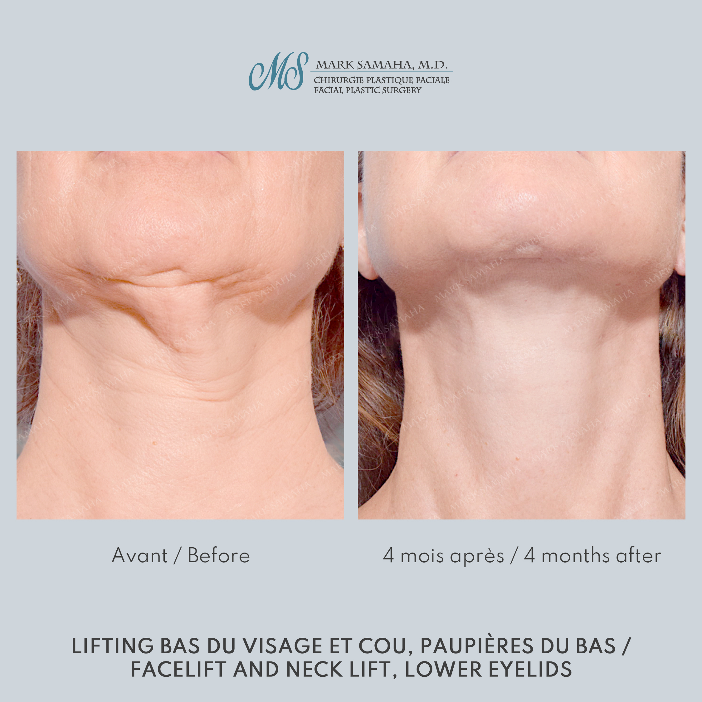 Before & After Lifting du visage / Cou - Facelift / Necklift Case 248 View #6 View in Montreal, QC