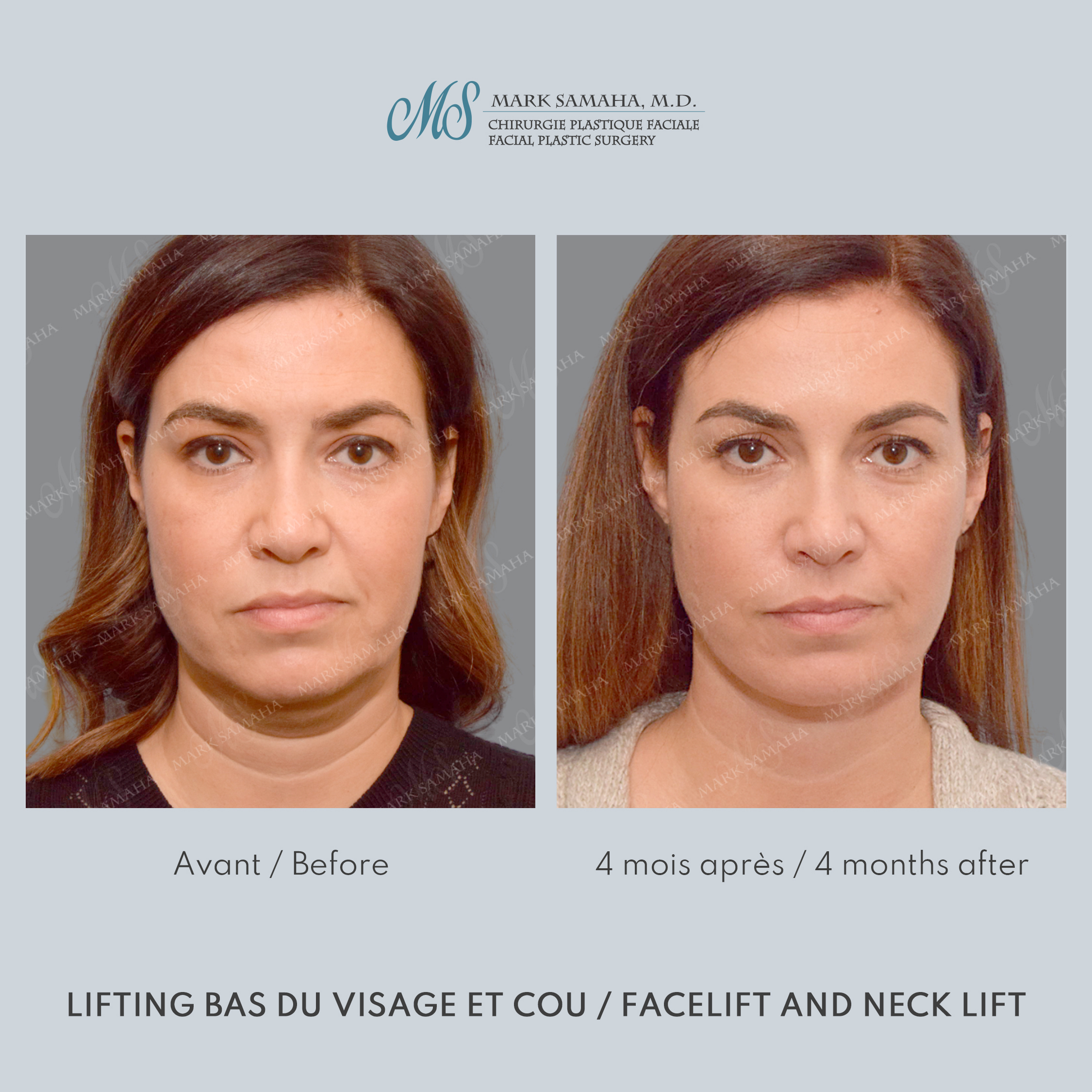 Before & After Lifting du visage / Cou - Facelift / Necklift Case 249 View #1 Detail View in Montreal, QC