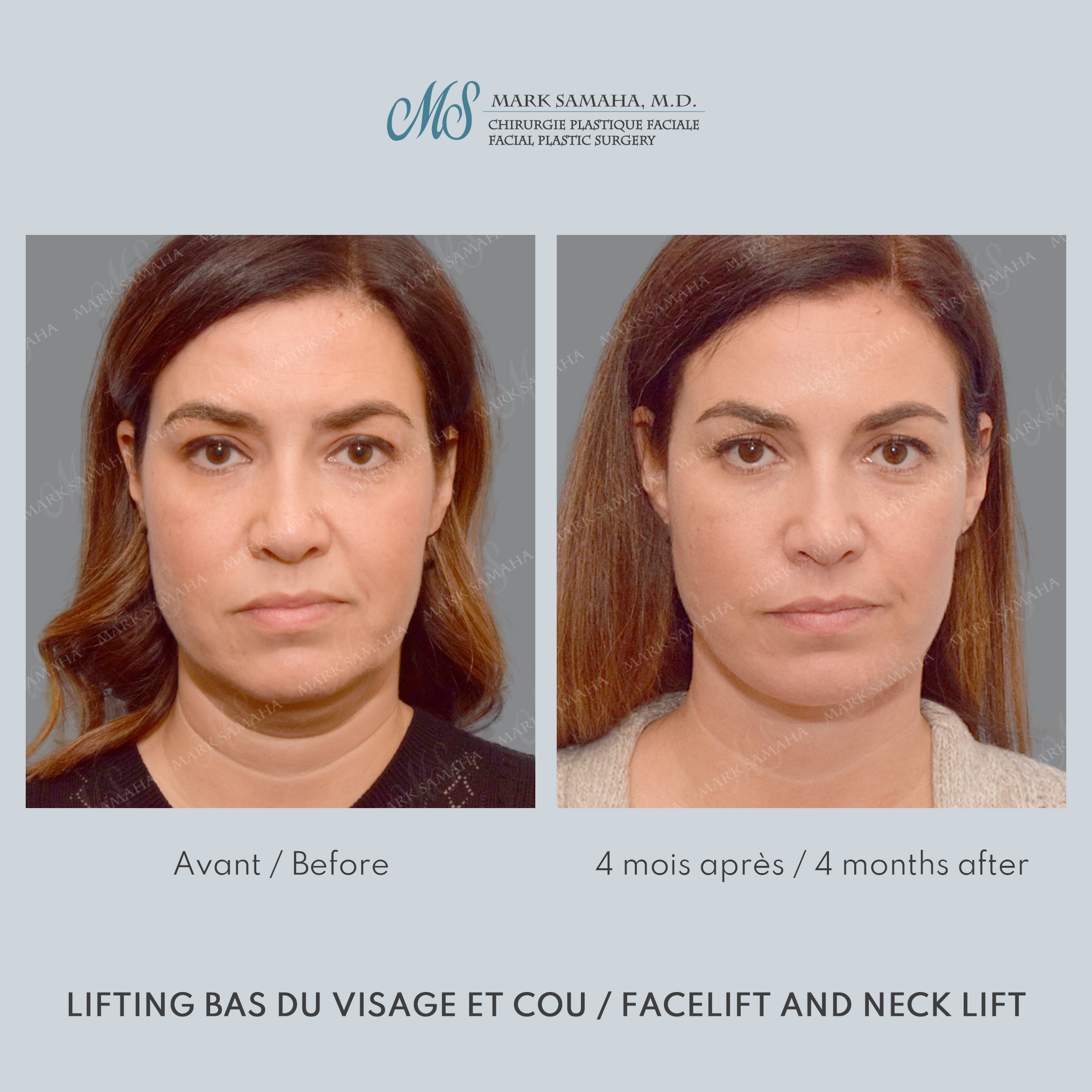 Before & After Lifting du visage / Cou - Facelift / Necklift Case 249 View #1 View in Montreal, QC